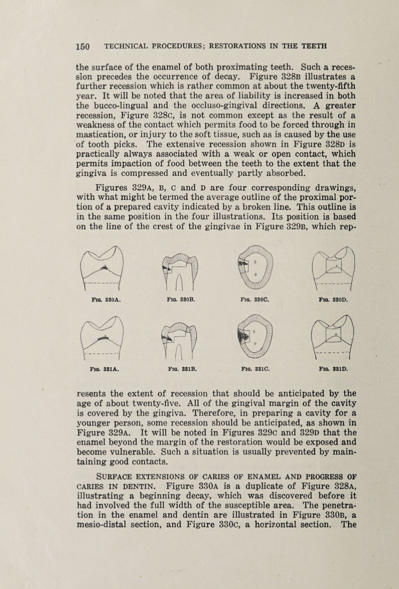 the surface of the enamel of both proximating teeth. Such a reces¬ sion precedes the occurrence of decay. Figure 328b illustrates a further recession which is rather common at about the twenty-fifth year. It will be noted that the area of liability is increased in both the bucco-lingual and the occluso-gingival directions. A greater recession, Figure 328c, is not common except as the result of a weakness of the contact which permits food to be forced through in mastication, or injury to the soft tissue, such as is caused by the use of tooth picks. The extensive recession shown in Figure 328d is practically always associated with a weak or open contact, which permits impaction of food between the teeth to the extent that the gingiva is compressed and eventually partly absorbed. Figures 329a, b, c and D are four corresponding drawings, with what might be termed the average outline of the proximal por¬ tion of a prepared cavity indicated by a broken line. This outline is in the same position in the four illustrations. Its position is based on the line of the crest of the gingivae in Figure 329b, which rep- Fig. 330C. Fig. 330D. resents the extent of recession that should be anticipated by the age of about twenty-five. All of the gingival margin of the cavity is covered by the gingiva. Therefore, in preparing a cavity for a younger person, some recession should be anticipated, as shown in Figure 329a. It will be noted in Figures 329c and 329d that the enamel beyond the margin of the restoration would be exposed and become vulnerable. Such a situation is usually prevented by main¬ taining good contacts. Surface extensions of caries of enamel and progress of caries in dentin. Figure 330a is a duplicate of Figure 328a, illustrating a beginning decay, which was discovered before it had involved the full width of the susceptible area. The penetra¬ tion in the enamel and dentin are illustrated in Figure 330b, a mesio-distal section, and Figure 330c, a horizontal section. The