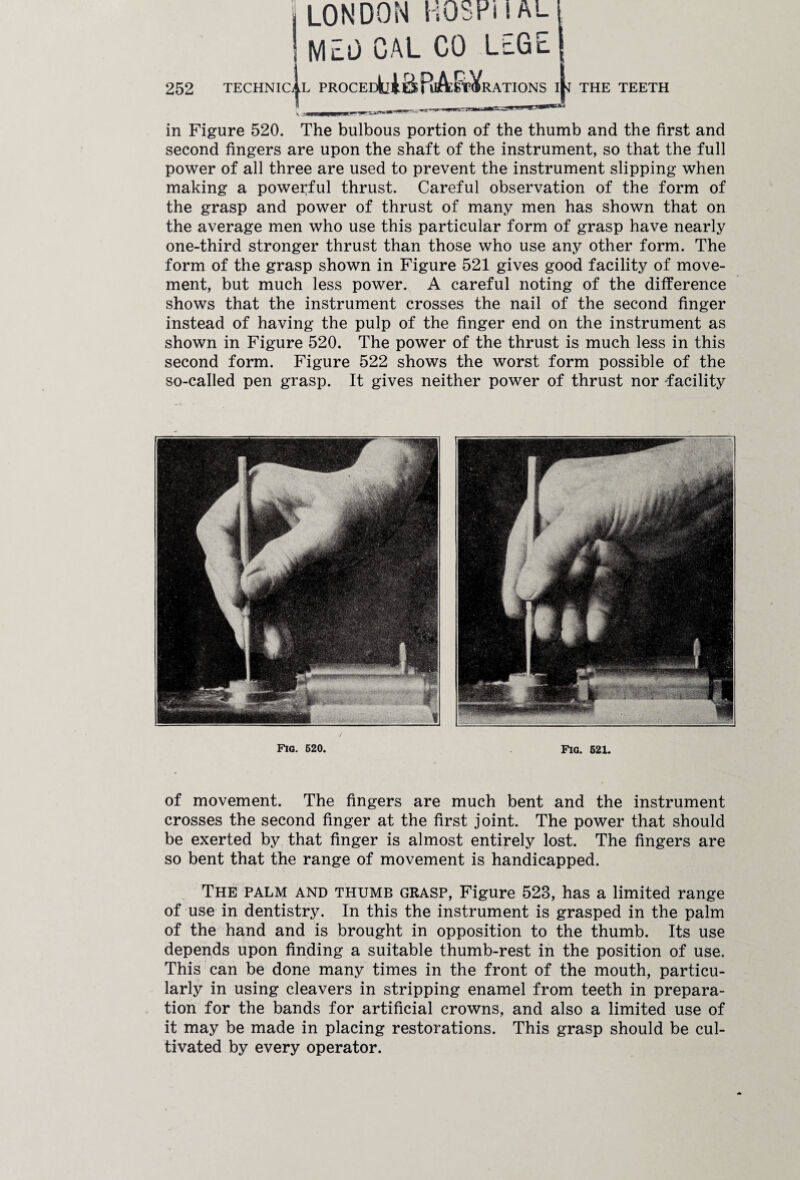 LONDON HQSPi I AI¬ MED CAL CO LEGE in Figure 520. The bulbous portion of the thumb and the first and second fingers are upon the shaft of the instrument, so that the full power of all three are used to prevent the instrument slipping when making a powerful thrust. Careful observation of the form of the grasp and power of thrust of many men has shown that on the average men who use this particular form of grasp have nearly one-third stronger thrust than those who use any other form. The form of the grasp shown in Figure 521 gives good facility of move¬ ment, but much less power. A careful noting of the difference shows that the instrument crosses the nail of the second finger instead of having the pulp of the finger end on the instrument as shown in Figure 520. The power of the thrust is much less in this second form. Figure 522 shows the worst form possible of the so-called pen grasp. It gives neither power of thrust nor -facility Fig. 520. Fig. 521. of movement. The fingers are much bent and the instrument crosses the second finger at the first joint. The power that should be exerted by that finger is almost entirely lost. The fingers are so bent that the range of movement is handicapped. The palm and thumb grasp, Figure 523, has a limited range of use in dentistry. In this the instrument is grasped in the palm of the hand and is brought in opposition to the thumb. Its use depends upon finding a suitable thumb-rest in the position of use. This can be done many times in the front of the mouth, particu¬ larly in using cleavers in stripping enamel from teeth in prepara¬ tion for the bands for artificial crowns, and also a limited use of it may be made in placing restorations. This grasp should be cul¬ tivated by every operator.