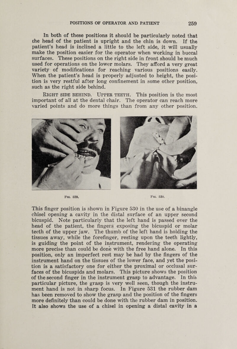 In both of these positions it should be particularly noted that che head of the patient is upright and the chin is down. If the patient’s head is inclined a little to the left side, it will usually make the position easier for the operator when working in buccal surfaces. These positions on the right side in front should be much used for operations on the lower molars. They afford a very great variety of modifications for reaching various positions easily. When the patient’s head is properly adjusted to height, the posi¬ tion is very restful after long confinement in some other position, such as the right side behind. Right side behind. Upper teeth. This position is the most important of all at the dental chair. The operator can reach more varied points and do more things than from any other position. Fig. 529. Fig. 530. This finger position is shown in Figure 530 in the use of a binangle chisel opening a cavity in the distal surface of an upper second bicuspid. Note particularly that the left hand is passed over the head of the patient, the fingers exposing the bicuspid or molar teeth of the upper jaw. The thumb of the left hand is holding the tissues away, while the forefinger, resting upon the teeth lightly, is guiding the point of the instrument, rendering the operating more precise than could be done with the free hand alone. In this position, only an imperfect rest may be had by the fingers of the instrument hand on the tissues of the lower face, and yet the posi¬ tion is a satisfactory one for either the proximal or occlusal sur¬ faces of the bicuspids and molars. This picture shows the position of the second finger in the instrument grasp to advantage. In this particular picture, the grasp is very well seen, though the instru¬ ment hand is not in sharp focus. In Figure 531 the rubber dam has been removed to show the grasp and the position of the fingers more definitely than could be done with the rubber dam in position. It also shows the use of a chisel in opening a distal cavity in a