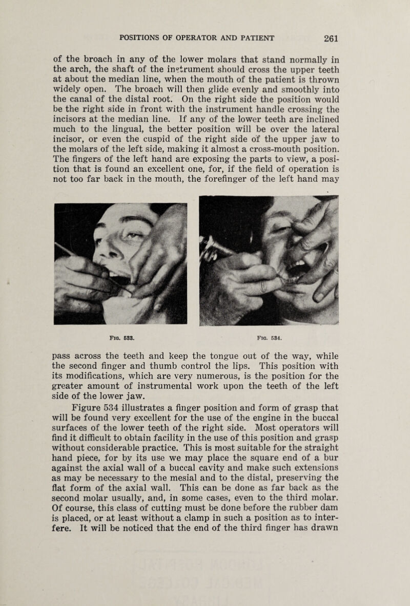 of the broach in any of the lower molars that stand normally in the arch, the shaft of the instrument should cross the upper teeth at about the median line, when the mouth of the patient is thrown widely open. The broach will then glide evenly and smoothly into the canal of the distal root. On the right side the position would be the right side in front with the instrument handle crossing the incisors at the median line. If any of the lower teeth are inclined much to the lingual, the better position will be over the lateral incisor, or even the cuspid of the right side of the upper jaw to the molars of the left side, making it almost a cross-mouth position. The fingers of the left hand are exposing the parts to view, a posi¬ tion that is found an excellent one, for, if the field of operation is not too far back in the mouth, the forefinger of the left hand may Fig. 633. Fig. 534. pass across the teeth and keep the tongue out of the way, while the second finger and thumb control the lips. This position with its modifications, which are very numerous, is the position for the greater amount of instrumental work upon the teeth of the left side of the lower jaw. Figure 5B4 illustrates a finger position and form of grasp that will be found very excellent for the use of the engine in the buccal surfaces of the lower teeth of the right side. Most operators will find it difficult to obtain facility in the use of this position and grasp without considerable practice. This is most suitable for the straight hand piece, for by its use we may place the square end of a bur against the axial wall of a buccal cavity and make such extensions as may be necessary to the mesial and to the distal, preserving the flat form of the axial wall. This can be done as far back as the second molar usually, and, in some cases, even to the third molar. Of course, this class of cutting must be done before the rubber dam is placed, or at least without a clamp in such a position as to inter¬ fere. It will be noticed that the end of the third finger has drawn