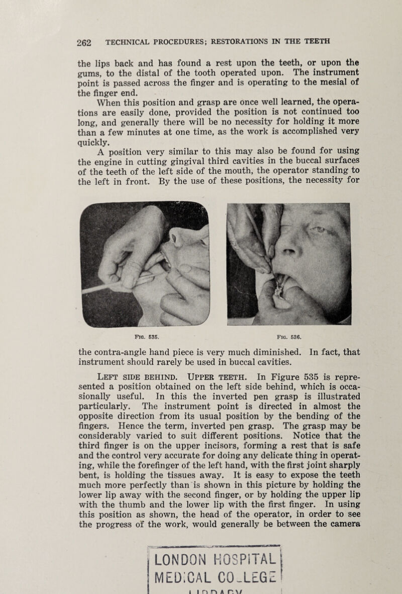 the lips back and has found a rest upon the teeth, or upon the gums, to the distal of the tooth operated upon. The instrument point is passed across the finger and is operating to the mesial of the finger end. When this position and grasp are once well learned, the opera¬ tions are easily done, provided the position is not continued too long, and generally there will be no necessity for holding it more than a few minutes at one time, as the work is accomplished very quickly. A position very similar to this may also be found for using the engine in cutting gingival third cavities in the buccal surfaces of the teeth of the left side of the mouth, the operator standing to the left in front. By the use of these positions, the necessity for Fig. 535. Fig. 536. the contra-angle hand piece is very much diminished. In fact, that instrument should rarely be used in buccal cavities. Left side behind. Upper teeth. In Figure 535 is repre¬ sented a position obtained on the left side behind, which is occa¬ sionally useful. In this the inverted pen grasp is illustrated particularly. The instrument point is directed in almost the opposite direction from its usual position by the bending of the fingers. Hence the term, inverted pen grasp. The grasp may be considerably varied to suit different positions. Notice that the third finger is on the upper incisors, forming a rest that is safe and the control very accurate for doing any delicate thing in operat¬ ing, while the forefinger of the left hand, with the first joint sharply bent, is holding the tissues away. It is easy to expose the teeth much more perfectly than is shown in this picture by holding the lower lip away with the second finger, or by holding the upper lip with the thumb and the lower lip with the first finger. In using this position as shown, the head of the operator, in order to see the progress of the work, would generally be between the camera LONDON HOSPiTAL MEDICAL CO-LEGZ