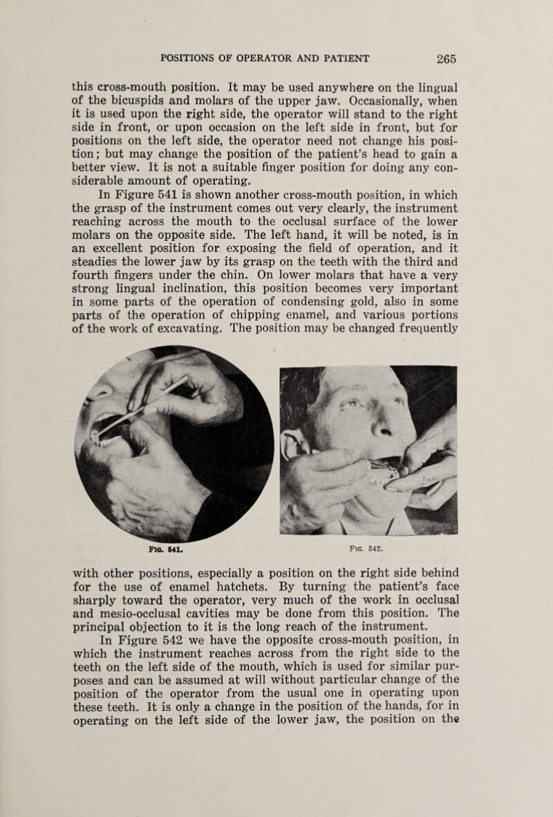 this cross-mouth position. It may be used anywhere on the lingual of the bicuspids and molars of the upper jaw. Occasionally, when it is used upon the right side, the operator will stand to the right side in front, or upon occasion on the left side in front, but for positions on the left side, the operator need not change his posi¬ tion; but may change the position of the patient’s head to gain a better view. It is not a suitable finger position for doing any con¬ siderable amount of operating. In Figure 541 is shown another cross-mouth position, in which the grasp of the instrument comes out very clearly, the instrument reaching across the mouth to the occlusal surface of the lower molars on the opposite side. The left hand, it will be noted, is in an excellent position for exposing the field of operation, and it steadies the lower jaw by its grasp on the teeth with the third and fourth fingers under the chin. On lower molars that have a very strong lingual inclination, this position becomes very important in some parts of the operation of condensing gold, also in some parts of the operation of chipping enamel, and various portions of the work of excavating. The position may be changed frequently with other positions, especially a position on the right side behind for the use of enamel hatchets. By turning the patient’s face sharply toward the operator, very much of the work in occlusal and mesio-occlusal cavities may be done from this position. The principal objection to it is the long reach of the instrument. In Figure 542 we have the opposite cross-mouth position, in which the instrument reaches across from the right side to the teeth on the left side of the mouth, which is used for similar pur¬ poses and can be assumed at will without particular change of the position of the operator from the usual one in operating upon these teeth. It is only a change in the position of the hands, for in operating on the left side of the lower jaw, the position on the