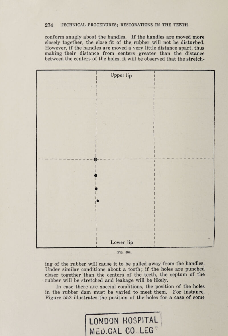 conform snugly about the handles. If the handles are moved more closely together, the close fit of the rubber will not be disturbed. However, if the handles are moved a very little distance apart, thus making their distance from centers greater than the distance between the centers of the holes, it will be observed that the stretch¬ ing of the rubber will cause it to be pulled away from the handles. Under similar conditions about a tooth; if the holes are punched closer together than the centers of the teeth, the septum of the rubber will be stretched and leakage will be likely. In case there are special conditions, the position of the holes in the rubber dam must be varied to meet them. For instance, Figure 552 illustrates the position of the holes for a case of some LONDON hospital: McD.CAL CO-LcG