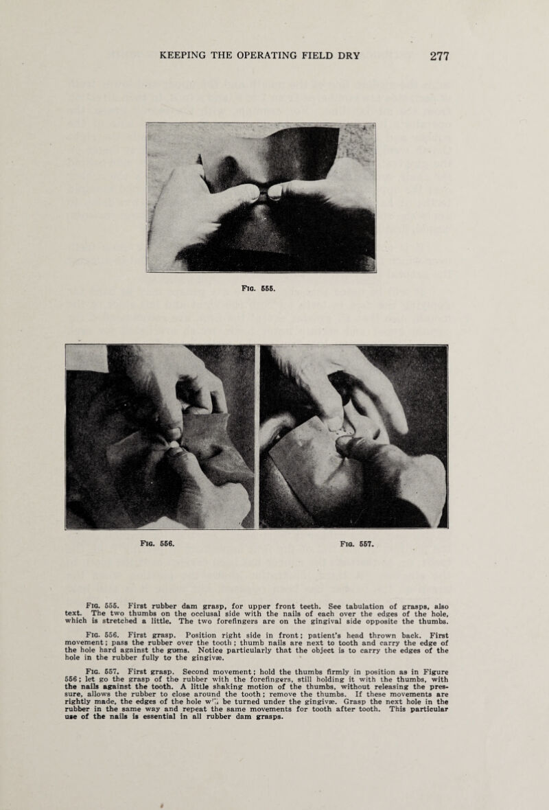 Fig. 656. Fig. 667. Fig. 556. First rubber dam grasp, for upper front teeth. See tabulation of grasps, also text. The two thumbs on the occlusal side with the nails of each over the edges of the hole, which is stretched a little. The two forefingers are on the gingival side opposite the thumbs. Fig. 556. First grasp. Position right side in front; patient’s head thrown back. First movement; pass the rubber over the tooth ; thumb nails are next to tooth and carry the edge of the hole hard against the gums. Notice particularly that the object is to carry the edges of the hole in the rubber fully to the gingivae. Fig. 557. First grasp. Second movement; hold the thumbs firmly in position as in Figure 566 ; let go the grasp of the rubber with the forefingers, still holding it with the thumbs, with the nails against the tooth. A little shaking motion of the thumbs, without releasing the pres¬ sure, allows the rubber to close around the tooth ; remove the thumbs. If these movements are rightly made, the edges of the hole w'a be turned under the gingivae. Grasp the next hole in the rubber in the same way and repeat the same movements for tooth after tooth. This particular use of the nails is essential in all rubber dam grasps. «