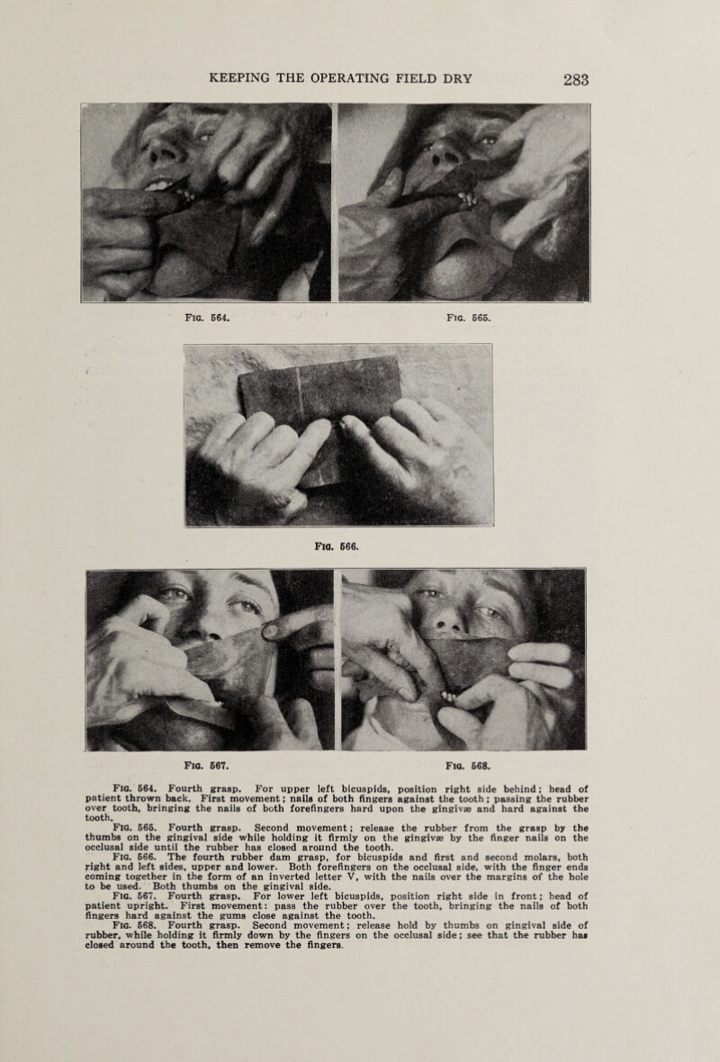 Fig. 664. Fig. 666. Fig. 666. Fig. 667. Fig. 668. Fig. 664. Fourth grasp. For upper left bicuspids, position right side behind; head of patient thrown back. First movement; nails of both fingers against the tooth; passing the rubber over tooth, bringing the nails of both forefingers hard upon the gingivae and hard against the tooth. Fig. 566. Fourth grasp. Second movement; release the rubber from the grasp by the thumbs on the gingival side while holding it firmly on the gingivae by the finger nails on the occlusal side until the rubber has closed around the tooth. Fig. 666. The fourth rubber dam grasp, for bicuspids and first and second molars, both right and left sides, upper and lower. Both forefingers on the occlusal side, with the finger ends coming together in the form of an inverted letter V, with the nails over the margins of the hole to be used. Both thumbs on the gingival side. Fig. 667. Fourth grasp. For lower left bicuspids, position right side in front; head of patient upright. First movement: pass the rubber over the tooth, bringing the nails of both fingers hard against the gums close against the tooth. Fig. 668. Fourth grasp. Second movement; release hold by thumbs on gingival side of rubber, while holding it firmly down by the fingers on the occlusal side; see that the rubber has closed around the tooth, then remove the fingers.