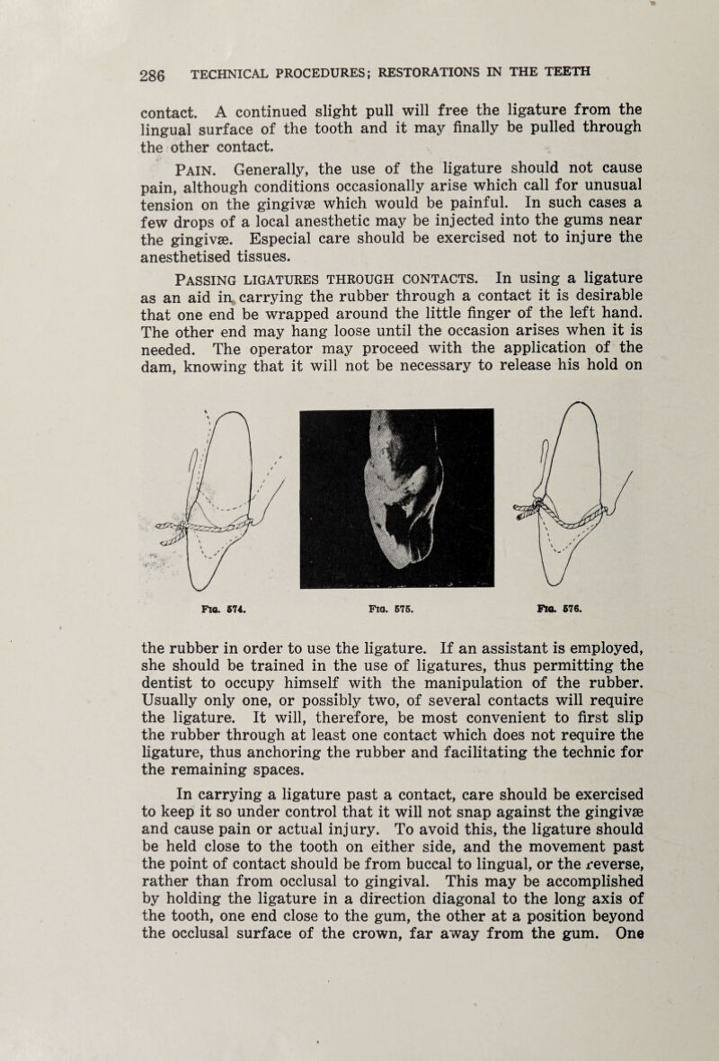 contact. A continued slight pull will free the ligature from the lingual surface of the tooth and it may finally be pulled through the other contact. Pain. Generally, the use of the ligature should not cause pain, although conditions occasionally arise which call for unusual tension on the gingivae which would be painful. In such cases a few drops of a local anesthetic may be injected into the gums near the gingivae. Especial care should be exercised not to injure the anesthetised tissues. Passing ligatures through contacts. In using a ligature as an aid in carrying the rubber through a contact it is desirable that one end be wrapped around the little finger of the left hand. The other end may hang loose until the occasion arises when it is needed. The operator may proceed with the application of the dam, knowing that it will not be necessary to release his hold on the rubber in order to use the ligature. If an assistant is employed, she should be trained in the use of ligatures, thus permitting the dentist to occupy himself with the manipulation of the rubber. Usually only one, or possibly two, of several contacts will require the ligature. It will, therefore, be most convenient to first slip the rubber through at least one contact which does not require the ligature, thus anchoring the rubber and facilitating the technic for the remaining spaces. In carrying a ligature past a contact, care should be exercised to keep it so under control that it will not snap against the gingivae and cause pain or actual injury. To avoid this, the ligature should be held close to the tooth on either side, and the movement past the point of contact should be from buccal to lingual, or the reverse, rather than from occlusal to gingival. This may be accomplished by holding the ligature in a direction diagonal to the long axis of the tooth, one end close to the gum, the other at a position beyond the occlusal surface of the crown, far away from the gum. One