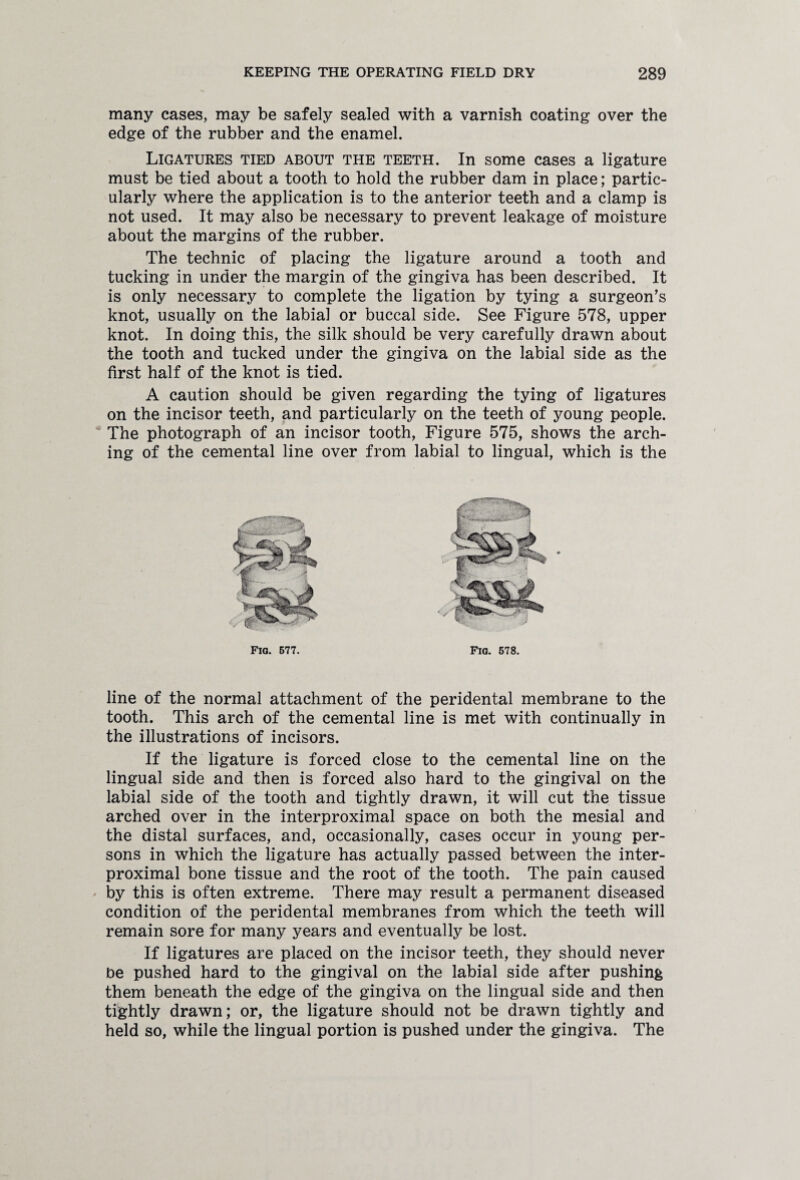 many cases, may be safely sealed with a varnish coating over the edge of the rubber and the enamel. Ligatures tied about the teeth. In some cases a ligature must be tied about a tooth to hold the rubber dam in place; partic¬ ularly where the application is to the anterior teeth and a clamp is not used. It may also be necessary to prevent leakage of moisture about the margins of the rubber. The technic of placing the ligature around a tooth and tucking in under the margin of the gingiva has been described. It is only necessary to complete the ligation by tying a surgeon’s knot, usually on the labial or buccal side. See Figure 578, upper knot. In doing this, the silk should be very carefully drawn about the tooth and tucked under the gingiva on the labial side as the first half of the knot is tied. A caution should be given regarding the tying of ligatures on the incisor teeth, and particularly on the teeth of young people. The photograph of an incisor tooth, Figure 575, shows the arch¬ ing of the cemental line over from labial to lingual, which is the line of the normal attachment of the peridental membrane to the tooth. This arch of the cemental line is met with continually in the illustrations of incisors. If the ligature is forced close to the cemental line on the lingual side and then is forced also hard to the gingival on the labial side of the tooth and tightly drawn, it will cut the tissue arched over in the interproximal space on both the mesial and the distal surfaces, and, occasionally, cases occur in young per¬ sons in which the ligature has actually passed between the inter¬ proximal bone tissue and the root of the tooth. The pain caused by this is often extreme. There may result a permanent diseased condition of the peridental membranes from which the teeth will remain sore for many years and eventually be lost. If ligatures are placed on the incisor teeth, they should never be pushed hard to the gingival on the labial side after pushing them beneath the edge of the gingiva on the lingual side and then tightly drawn; or, the ligature should not be drawn tightly and held so, while the lingual portion is pushed under the gingiva. The