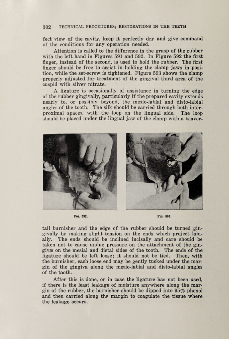 feet view of the cavity, keep it perfectly dry and give command of the conditions for any operation needed. Attention is called to the difference in the grasp of the rubber with the left hand in Figures 591 and 592. In Figure 592 the first finger, instead of the second, is used to hold the rubber. The first finger should be free to assist in holding the clamp jaws in posi¬ tion, while the set-screw is tightened. Figure 593 shows the clamp properly adjusted for treatment of the gingival third area of the cuspid with silver nitrate. A ligature is occasionally of assistance in turning the edge of the rubber gingivally, particularly if the prepared cavity extends nearly to, or possibly beyond, the mesio-labial and disto-labial angles of the tooth. The silk should be carried through both inter- proximal spaces, with the loop on the lingual side. The loop should be placed under the lingual jaw of the clamp with a beaver- Fio. 692. Fig. 693. tail burnisher and the edge of the rubber should be turned gin¬ givally by making slight tension on the ends which project labi- ally. The ends should be inclined incisally and care should be taken not to cause undue pressure on the attachment of the gin¬ givae on the mesial and distal sides of the tooth. The ends of the ligature should be left loose; it should not be tied. Then, with the burnisher, each loose end may be gently tucked under the mar¬ gin of the gingiva along the mesio-labial and disto-labial angles of the tooth. After this is done, or in case the ligature has not been used, if there is the least leakage of moisture anywhere along the mar¬ gin of the rubber, the burnisher should be dipped into 95% phenol and then carried along the margin to coagulate the tissue where the leakage occurs.