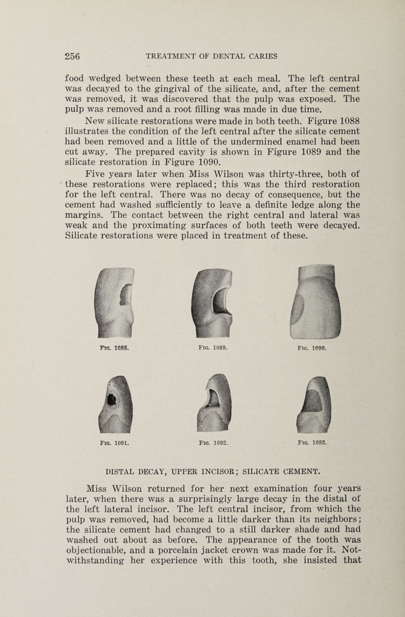 food wedged between these teeth at each meal. The left central was decayed to the gingival of the silicate, and, after the cement was removed, it was discovered that the pulp was exposed. The pulp was removed and a root filling was made in due time. New silicate restorations were made in both teeth. Figure 1088 illustrates the condition of the left central after the silicate cement had been removed and a little of the undermined enamel had been cut away. The prepared cavity is shown in Figure 1089 and the silicate restoration in Figure 1090. Five years later when Miss Wilson was thirty-three, both of these restorations were replaced; this was the third restoration for the left central. There was no decay of consequence, but the cement had washed sufficiently to leave a definite ledge along the margins. The contact between the right central and lateral was weak and the proximating surfaces of both teeth were decayed. Silicate restorations were placed in treatment of these. Fig. 1089. Fig. 1090. Fig. 1088. Fig. 1091. Fig. 1092. Fig. 1093. DISTAL DECAY, UPPER INCISOR; SILICATE CEMENT. Miss Wilson returned for her next examination four years later, when there was a surprisingly large decay in the distal of the left lateral incisor. The left central incisor, from which the pulp was removed, had become a little darker than its neighbors; the silicate cement had changed to a still darker shade and had washed out about as before. The appearance of the tooth was objectionable, and a porcelain jacket crown was made for it. Not¬ withstanding her experience with this tooth, she insisted that