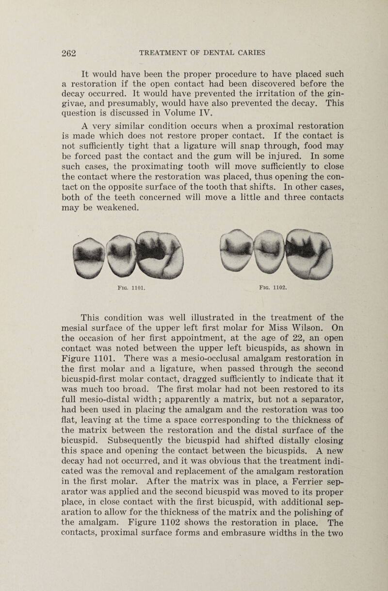 It would have been the proper procedure to have placed such a restoration if the open contact had been discovered before the decay occurred. It would have prevented the irritation of the gin¬ givae, and presumably, would have also prevented the decay. This question is discussed in Volume IV. A very similar condition occurs when a proximal restoration is made which does not restore proper contact. If the contact is not sufficiently tight that a ligature will snap through, food may be forced past the contact and the gum will be injured. In some such cases, the proximating tooth will move sufficiently to close the contact where the restoration was placed, thus opening the con¬ tact on the opposite surface of the tooth that shifts. In other cases, both of the teeth concerned will move a little and three contacts may be weakened. Fig. 1101. Fig. 1102. This condition was well illustrated in the treatment of the mesial surface of the upper left first molar for Miss Wilson. On the occasion of her first appointment, at the age of 22, an open contact was noted between the upper left bicuspids, as shown in Figure 1101. There was a mesio-occlusal amalgam restoration in the first molar and a ligature, when passed through the second bicuspid-first molar contact, dragged sufficiently to indicate that it was much too broad. The first molar had not been restored to its full mesio-distal width; apparently a matrix, but not a separator, had been used in placing the amalgam and the restoration was too flat, leaving at the time a space corresponding to the thickness of the matrix between the restoration and the distal surface of the bicuspid. Subsequently the bicuspid had shifted distally closing this space and opening the contact between the bicuspids. A new decay had not occurred, and it was obvious that the treatment indi¬ cated was the removal and replacement of the amalgam restoration in the first molar. After the matrix was in place, a Ferrier sep¬ arator was applied and the second bicuspid was moved to its proper place, in close contact with the first bicuspid, with additional sep¬ aration to allow for the thickness of the matrix and the polishing of the amalgam. Figure 1102 shows the restoration in place. The contacts, proximal surface forms and embrasure widths in the two