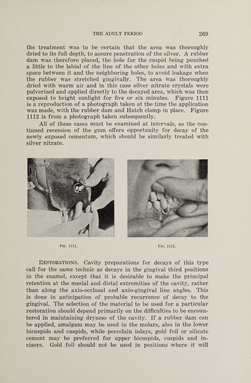 the treatment was to be certain that the area was thoroughly dried to its full depth, to assure penetration of the silver. A rubber dam was therefore placed, the hole for the cuspid being punched a little to the labial of the line of the other holes and with extra space between it and the neighboring holes, to avoid leakage when the rubber was stretched gingivally. The area was thoroughly dried with warm air and in this case silver nitrate crystals were pulverized and applied directly to the decayed area, which was then exposed to bright sunlight for five or six minutes. Figure 1111 is a reproduction of a photograph taken at the time the application was made, with the rubber dam and Hatch clamp in place. Figure 1112 is from a photograph taken subsequently. All of these cases must be examined at intervals, as the con¬ tinued recession of the gum offers opportunity for decay of the newly exposed cementum, which should be similarly treated with silver nitrate. Fig. 1111. Fig. 1112. Restorations. Cavity preparations for decays of this type call for the same technic as decays in the gingival third positions in the enamel, except that it is desirable to make the principal retention at the mesial and distal extremities of the cavity, rather than along the axio-occlusal and axio-gingival line angles. This is done in anticipation of probable recurrence of decay to the gingival. The selection of the material to be used for a particular restoration should depend primarily on the difficulties to be encoun¬ tered in maintaining dryness of the cavity. If a rubber dam can be applied, amalgam may be used in the molars, also in the lower bicuspids and cuspids, while porcelain inlays, gold foil or silicate cement may be preferred for upper bicuspids, cuspids and in¬ cisors. Gold foil should not be used in positions where it will