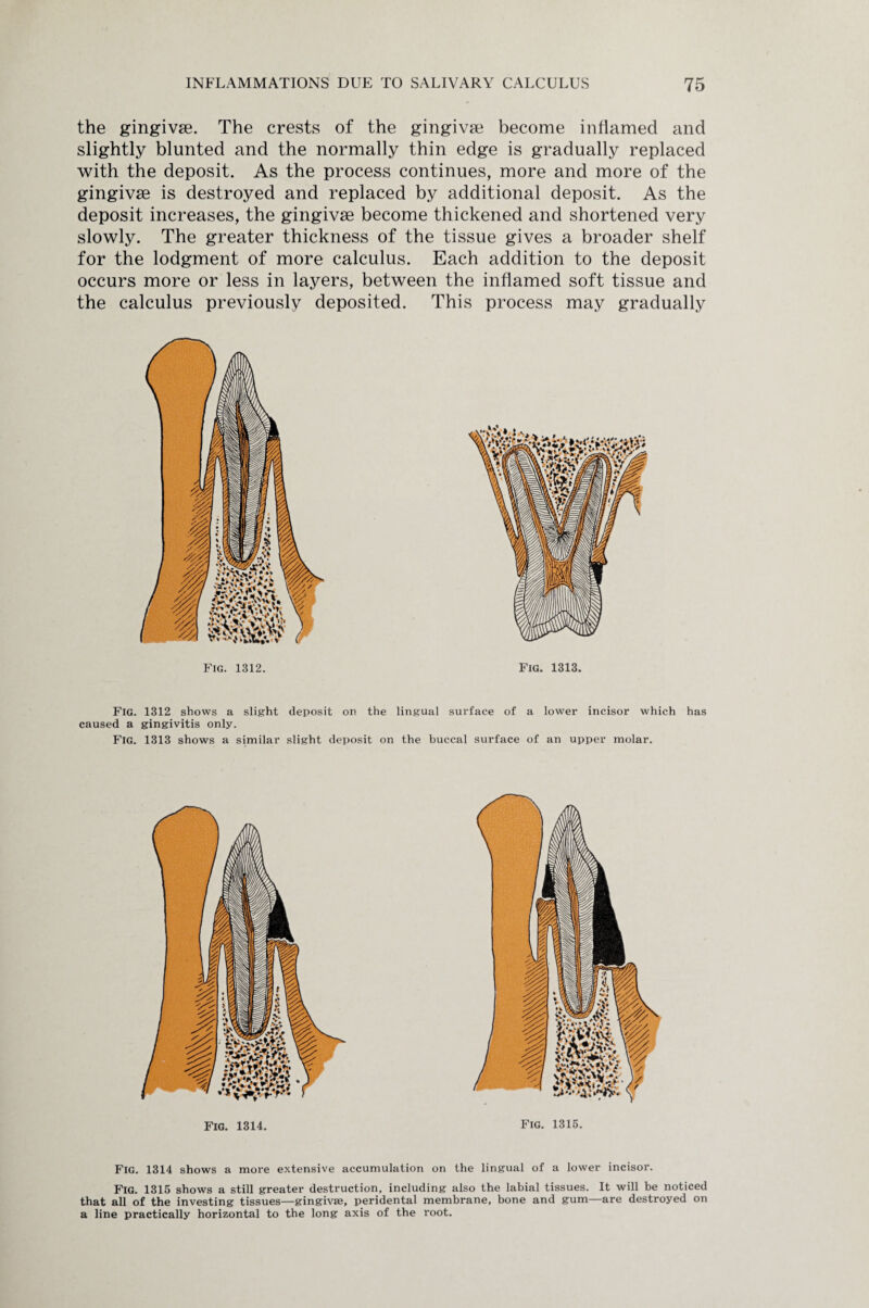 the gingivae. The crests of the gingivae become inflamed and slightly blunted and the normally thin edge is gradually replaced with the deposit. As the process continues, more and more of the gingivae is destroyed and replaced by additional deposit. As the deposit increases, the gingivae become thickened and shortened very slowly. The greater thickness of the tissue gives a broader shelf for the lodgment of more calculus. Each addition to the deposit occurs more or less in layers, between the inflamed soft tissue and the calculus previously deposited. This process may gradually Fig. 1312. Fig. 1313. Fig. 1312 shows a slight deposit on the lingual surface of a lower incisor which has caused a gingivitis only. Fig. 1313 shows a similar slight deposit on the buccal surface of an upper molar. Fig. 1314. Fig. 1314 shows a more extensive accumulation on the lingual of a lower incisor. Fig. 1315 shows a still greater destruction, including also the labial tissues. It will be noticed that all of the investing tissues—gingivae, peridental membrane, bone and gum—are destroyed on a line practically horizontal to the long axis of the root.