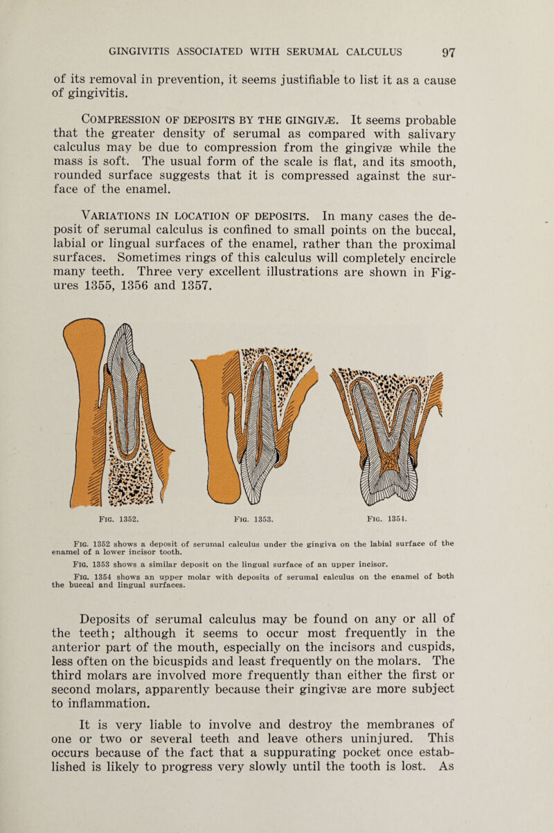 of its removal in prevention, it seems justifiable to list it as a cause of gingivitis. Compression of deposits by the gingivae. It seems probable that the greater density of serumal as compared with salivary calculus may be due to compression from the gingivae while the mass is soft. The usual form of the scale is flat, and its smooth, rounded surface suggests that it is compressed against the sur¬ face of the enamel. Variations in location of deposits. In many cases the de¬ posit of serumal calculus is confined to small points on the buccal, labial or lingual surfaces of the enamel, rather than the proximal surfaces. Sometimes rings of this calculus will completely encircle many teeth. Three very excellent illustrations are shown in Fig¬ ures 1355, 1356 and 1357. Fig. 1353. Fig. 1354. Fig. 1352 shows a deposit of serumal calculus under the gingiva on the labial surface of the enamel of a lower incisor tooth. Fig. 1353 shows a similar deposit on the lingual surface of an upper incisor. Fig. 1354 shows an upper molar with deposits of serumal calculus on the enamel of both the buccal and lingual surfaces. Deposits of serumal calculus may be found on any or all of the teeth; although it seems to occur most frequently in the anterior part of the mouth, especially on the incisors and cuspids, less often on the bicuspids and least frequently on the molars. The third molars are involved more frequently than either the first or second molars, apparently because their gingivae are more subject to inflammation. It is very liable to involve and destroy the membranes of one or two or several teeth and leave others uninjured. This occurs because of the fact that a suppurating pocket once estab¬ lished is likely to progress very slowly until the tooth is lost. As