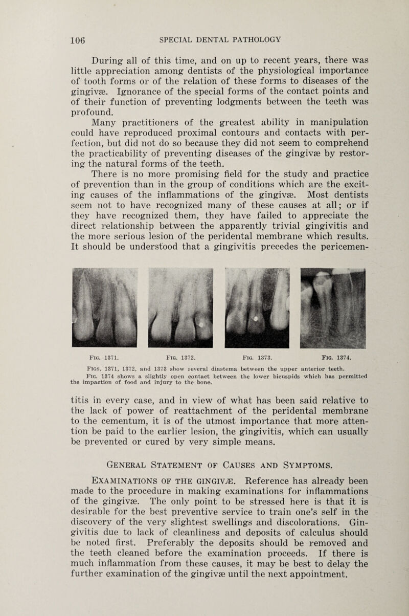 During all of this time, and on up to recent years, there was little appreciation among dentists of the physiological importance of tooth forms or of the relation of these forms to diseases of the gingivae. Ignorance of the special forms of the contact points and of their function of preventing lodgments between the teeth was profound. Many practitioners of the greatest ability in manipulation could have reproduced proximal contours and contacts with per¬ fection, but did not do so because they did not seem to comprehend the practicability of preventing diseases of the gingivae by restor¬ ing the natural forms of the teeth. There is no more promising field for the study and practice of prevention than in the group of conditions which are the excit¬ ing causes of the inflammations of the gingivae. Most dentists seem not to have recognized many of these causes at all; or if they have recognized them, they have failed to appreciate the direct relationship between the apparently trivial gingivitis and the more serious lesion of the peridental membrane which results. It should be understood that a gingivitis precedes the pericemen- Fig. 1371. Fig. 1372. Fig. 1373. Fig. 1374. Figs. 1371, 1372, and 1373 show several diastema between the upper anterior teeth. Fig. 1374 shows a slightly open contact between the lower bicuspids which has permitted the impaction of food and injury to the bone. titis in every case, and in view of what has been said relative to the lack of power of reattachment of the peridental membrane to the cementum, it is of the utmost importance that more atten¬ tion be paid to the earlier lesion, the gingivitis, which can usually be prevented or cured by very simple means. General Statement of Causes and Symptoms. Examinations of the gingiva. Reference has already been made to the procedure in making examinations for inflammations of the gingivae. The only point to be stressed here is that it is desirable for the best preventive service to train one’s self in the discovery of the very slightest swellings and discolorations. Gin¬ givitis due to lack of cleanliness and deposits of calculus should be noted first. Preferably the deposits should be removed and the teeth cleaned before the examination proceeds. If there is much inflammation from these causes, it may be best to delay the further examination of the gingivae until the next appointment.