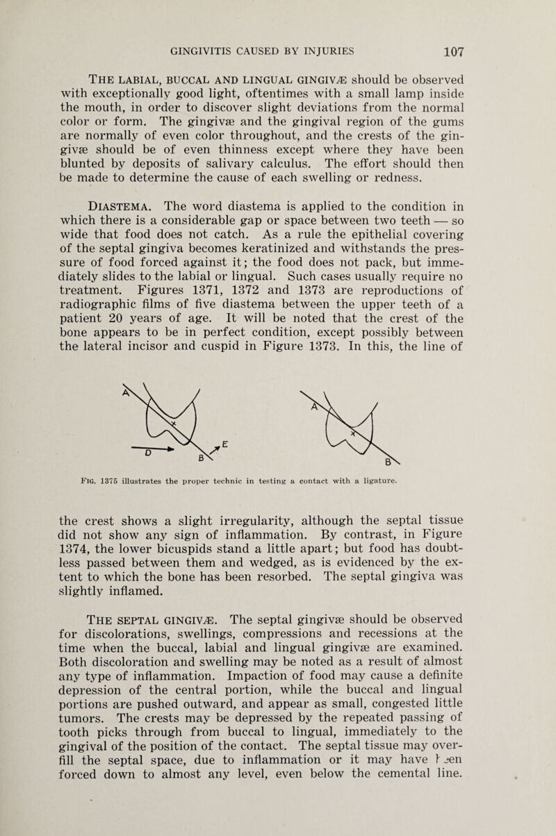 The labial, buccal and lingual gingivae should be observed with exceptionally good light, oftentimes with a small lamp inside the mouth, in order to discover slight deviations from the normal color or form. The gingivae and the gingival region of the gums are normally of even color throughout, and the crests of the gin¬ givae should be of even thinness except where they have been blunted by deposits of salivary calculus. The effort should then be made to determine the cause of each swelling or redness. Diastema. The word diastema is applied to the condition in which there is a considerable gap or space between two teeth — so wide that food does not catch. As a rule the epithelial covering of the septal gingiva becomes keratinized and withstands the pres¬ sure of food forced against it; the food does not pack, but imme¬ diately slides to the labial or lingual. Such cases usually require no treatment. Figures 1371, 1372 and 1373 are reproductions of radiographic films of five diastema between the upper teeth of a patient 20 years of age. It will be noted that the crest of the bone appears to be in perfect condition, except possibly between the lateral incisor and cuspid in Figure 1373. In this, the line of Fig. 1375 illustrates the proper technic in testing a contact with a ligature. the crest shows a slight irregularity, although the septal tissue did not show any sign of inflammation. By contrast, in Figure 1374, the lower bicuspids stand a little apart; but food has doubt¬ less passed between them and wedged, as is evidenced by the ex¬ tent to which the bone has been resorbed. The septal gingiva was slightly inflamed. The septal gingivae. The septal gingivae should be observed for discolorations, swellings, compressions and recessions at the time when the buccal, labial and lingual gingivae are examined. Both discoloration and swelling may be noted as a result of almost any type of inflammation. Impaction of food may cause a definite depression of the central portion, while the buccal and lingual portions are pushed outward, and appear as small, congested little tumors. The crests may be depressed by the repeated passing of tooth picks through from buccal to lingual, immediately to the gingival of the position of the contact. The septal tissue may over¬ fill the septal space, due to inflammation or it may have \ een forced down to almost any level, even below the cemental line.