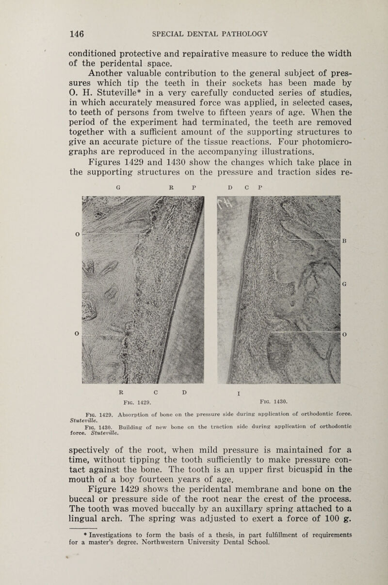 conditioned protective and repairative measure to reduce the width of the peridental space. Another valuable contribution to the general subject of pres¬ sures which tip the teeth in their sockets has been made by 0. H. Stuteville* in a very carefully conducted series of studies, in which accurately measured force was applied, in selected cases, to teeth of persons from twelve to fifteen years of age. When the period of the experiment had terminated, the teeth are removed together with a sufficient amount of the supporting structures to give an accurate picture of the tissue reactions. Four photomicro¬ graphs are reproduced in the accompanying illustrations. Figures 1429 and 1430 show the changes which take place in the supporting structures on the pressure and traction sides re- G R R P C D D C P I Fig. 1429. Fig. 1430. Fig. 1429. Absorption of bone on the pressure side during application of orthodontic force. Stuteville. Fig. 1430. Building of new bone on the traction side during application of orthodontic force. Stuteville. spectively of the root, when mild pressure is maintained for a time, without tipping the tooth sufficiently to make pressure con¬ tact against the bone. The tooth is an upper first bicuspid in the mouth of a boy fourteen years of age. Figure 1429 shows the peridental membrane and bone on the buccal or pressure side of the root near the crest of the process. The tooth was moved buccally by an auxiliary spring attached to a lingual arch. The spring was adjusted to exert a force of 100 g. * Investigations to form the basis of a thesis, in part fulfillment of requirements for a master’s degree. Northwestern University Dental School.