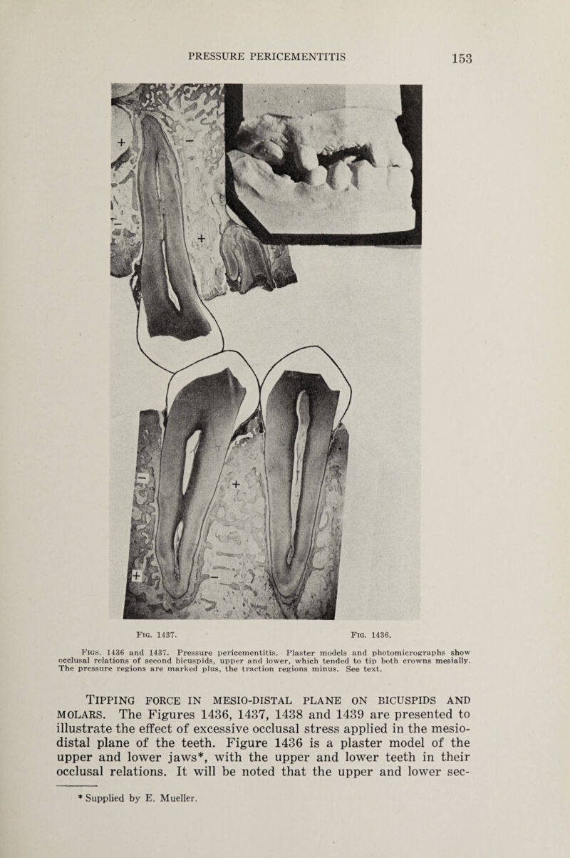 Fig. 1437. Fig. 1436. Figs. 1436 and 1437. Pressure pericementitis. Plaster models and photomicrographs show occlusal relations of second bicuspids, upper and lower, which tended to tip both crowns mesially. The pressure regions are marked plus, the traction regions minus. See text. Tipping force in mesio-distal plane on bicuspids and molars. The Figures 1436, 1437, 1438 and 1439 are presented to illustrate the effect of excessive occlusal stress applied in the mesio- distal plane of the teeth. Figure 1436 is a plaster model of the upper and lower jaws*, with the upper and lower teeth in their occlusal relations. It will be noted that the upper and lower sec- * Supplied by E. Mueller.