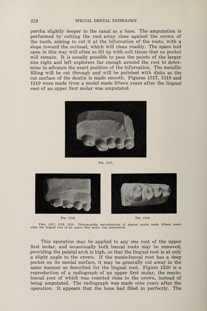 percha slightly deeper in the canal as a base. The amputation is performed by cutting the root away close against the crown of the tooth, aiming to cut it at the bifurcation of the roots, with a slope toward the occlusal, which will clean readily. The space laid open in this way will often so fill up with soft tissue that no pocket will remain. It is usually possible to pass the points of the larger size right and left explorers far enough around the root to deter¬ mine in advance the exact position of the bifurcation. The metallic filling will be cut through and will be polished with disks as the cut surface of the dentin is made smooth. Figures 1517, 1518 and 1519 were made from a model made fifteen years after the lingual root of an upper first molar was amputated. Fig. 1517. Fig. 1518. Fig. 1519. Figs. 1517, 1518, 1519. Photographic reproductions of plaster model made fifteen years after the lingual root of an upper first molar was amputated. This operation may be applied to any one root of the upper first molar, and occasionally both buccal roots may be removed, providing the palatal arch is high, so that the lingual root is at only a slight angle to the crown. If the mesio-buccal root has a deep pocket on its mesial surface, it may be generally cut away in the same manner as described for the lingual root. Figure 1520 is a reproduction of a radiograph of an upper first molar, the mesio- buccal root of which was resected close to the crown, instead of being amputated. The radiograph was made nine years after the operation. It appears that the bone had filled in perfectly. The