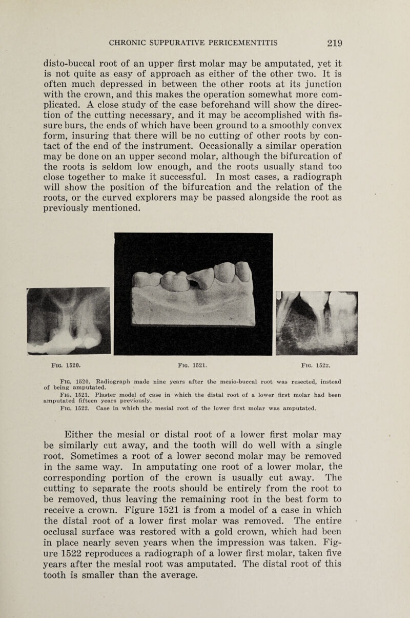 disto-buccal root of an upper first molar may be amputated, yet it is not quite as easy of approach as either of the other two. It is often much depressed in between the other roots at its junction with the crown, and this makes the operation somewhat more com¬ plicated. A close study of the case beforehand will show the direc¬ tion of the cutting necessary, and it may be accomplished with fis¬ sure burs, the ends of which have been ground to a smoothly convex form, insuring that there will be no cutting of other roots by con¬ tact of the end of the instrument. Occasionally a similar operation may be done on an upper second molar, although the bifurcation of the roots is seldom low enough, and the roots usually stand too close together to make it successful. In most cases, a radiograph will show the position of the bifurcation and the relation of the roots, or the curved explorers may be passed alongside the root as previously mentioned. Fig. 1520. Fig. 1521. Fig. 1522. Fig. 1520. Radiograph made nine years after the mesio-buccal root was resected, instead of being amputated. Fig. 1521. Plaster model of case in which the distal root of a lower first molar had been amputated fifteen years previously. Fig. 1522. Case in which the mesial root of the lower first molar was amputated. Either the mesial or distal root of a lower first molar may be similarly cut away, and the tooth will do well with a single root. Sometimes a root of a lower second molar may be removed in the same way. In amputating one root of a lower molar, the corresponding portion of the crown is usually cut away. The cutting to separate the roots should be entirely from the root to be removed, thus leaving the remaining root in the best form to receive a crown. Figure 1521 is from a model of a case in which the distal root of a lower first molar was removed. The entire occlusal surface was restored with a gold crown, which had been in place nearly seven years when the impression was taken. Fig¬ ure 1522 reproduces a radiograph of a lower first molar, taken five years after the mesial root was amputated. The distal root of this tooth is smaller than the average.