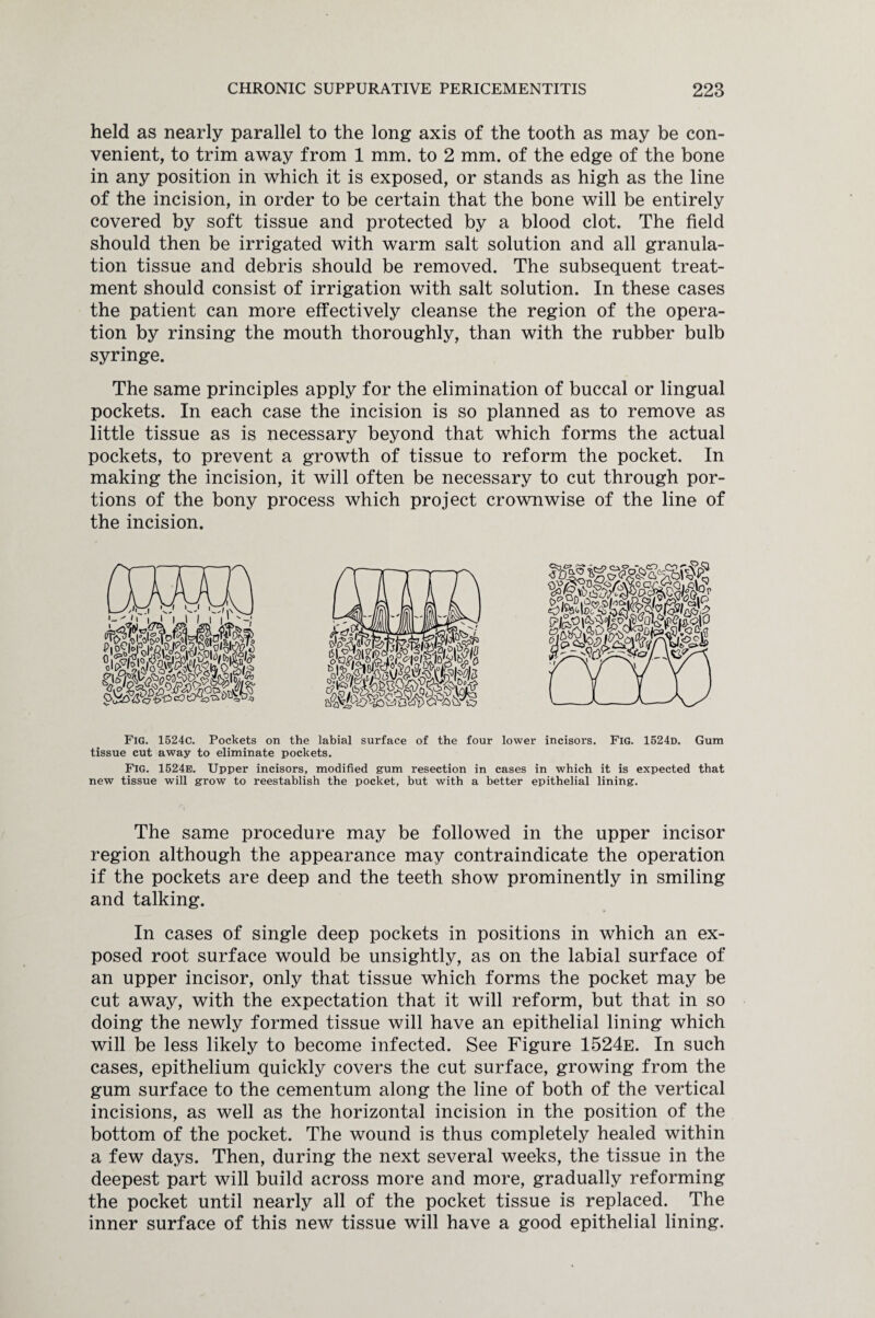 held as nearly parallel to the long axis of the tooth as may be con¬ venient, to trim away from 1 mm. to 2 mm. of the edge of the bone in any position in which it is exposed, or stands as high as the line of the incision, in order to be certain that the bone will be entirely covered by soft tissue and protected by a blood clot. The field should then be irrigated with warm salt solution and all granula¬ tion tissue and debris should be removed. The subsequent treat¬ ment should consist of irrigation with salt solution. In these cases the patient can more effectively cleanse the region of the opera¬ tion by rinsing the mouth thoroughly, than with the rubber bulb syringe. The same principles apply for the elimination of buccal or lingual pockets. In each case the incision is so planned as to remove as little tissue as is necessary beyond that which forms the actual pockets, to prevent a growth of tissue to reform the pocket. In making the incision, it will often be necessary to cut through por¬ tions of the bony process which project crownwise of the line of the incision. Fig. 1524c. Pockets on the labial surface of the four lower incisors. Fig. 1524d. Gum tissue cut away to eliminate pockets. Fig. 1524b. Upper incisors, modified gum resection in cases in which it is expected that new tissue will grow to reestablish the pocket, but with a better epithelial lining. The same procedure may be followed in the upper incisor region although the appearance may contraindicate the operation if the pockets are deep and the teeth show prominently in smiling and talking. In cases of single deep pockets in positions in which an ex¬ posed root surface would be unsightly, as on the labial surface of an upper incisor, only that tissue which forms the pocket may be cut away, with the expectation that it will reform, but that in so doing the newly formed tissue will have an epithelial lining which will be less likely to become infected. See Figure 1524e. In such cases, epithelium quickly covers the cut surface, growing from the gum surface to the cementum along the line of both of the vertical incisions, as well as the horizontal incision in the position of the bottom of the pocket. The wound is thus completely healed within a few days. Then, during the next several weeks, the tissue in the deepest part will build across more and more, gradually reforming the pocket until nearly all of the pocket tissue is replaced. The inner surface of this new tissue will have a good epithelial lining.