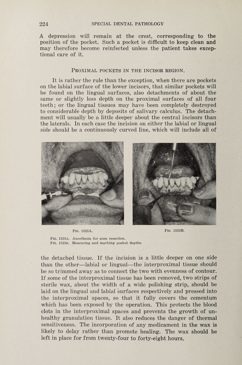 A depression will remain at the crest, corresponding to the position of the pocket. Such a pocket is difficult to keep clean and may therefore become reinfected unless the patient takes excep¬ tional care of it. Proximal pockets in the incisor region. It is rather the rule than the exception, when there are pockets on the labial surface of the lower incisors, that similar pockets will be found on the lingual surfaces, also detachments of about the same or slightly less depth on the proximal surfaces of all four teeth; or the lingual tissues may have been completely destroyed to considerable depth by deposits of salivary calculus. The detach¬ ment will usually be a little deeper about the central incisors than the laterals. In each case the incision on either the labial or lingual side should be a continuously curved line, which will include all of Fig. 1525A. Fig. 1525a. Anesthesia for gum resection. Fig. 1525b. Measuring and marking pocket Fig. 1525B. depths. the detached tissue. If the incision is a little deeper on one side than the other—labial or lingual—the interproximal tissue should be so trimmed away as to connect the two with evenness of contour. If some of the interproximal tissue has been removed, two strips of sterile wax, about the width of a wide polishing strip, should be laid on the lingual and labial surfaces respectively and pressed into the interproximal spaces, so that it fully covers the cementum which has been exposed by the operation. This protects the blood clots in the interproximal spaces and prevents the growth of un¬ healthy granulation tissue. It also reduces the danger of thermal sensitiveness. The incorporation of any medicament in the wax is likely to delay rather than promote healing. The wax should be left in place for from twenty-four to forty-eight hours.