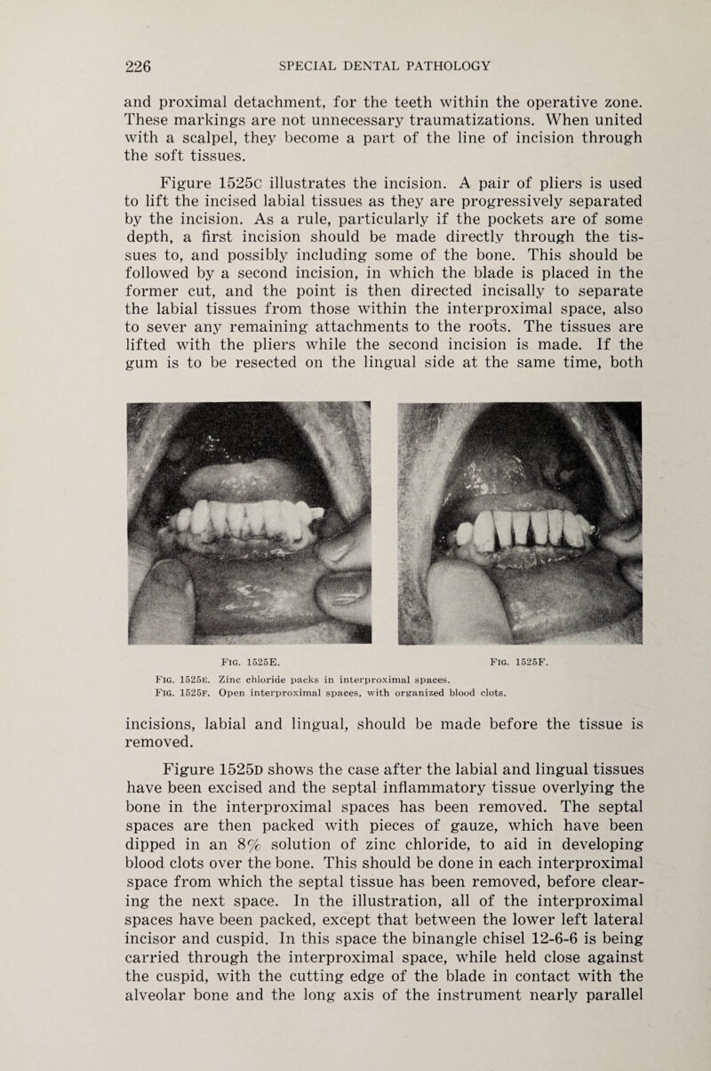 and proximal detachment, for the teeth within the operative zone. These markings are not unnecessary traumatizations. When united with a scalpel, they become a part of the line of incision through the soft tissues. Figure 1525c illustrates the incision. A pair of pliers is used to lift the incised labial tissues as they are progressively separated by the incision. As a rule, particularly if the pockets are of some depth, a first incision should be made directly through the tis¬ sues to, and possibly including some of the bone. This should be followed by a second incision, in which the blade is placed in the former cut, and the point is then directed incisally to separate the labial tissues from those within the interproximal space, also to sever any remaining attachments to the roofs. The tissues are lifted with the pliers while the second incision is made. If the gum is to be resected on the lingual side at the same time, both Fig. 1525E. Fig. 1525F. Fig. 1525e. Zinc chloride packs in interproximal spaces. FlG. 1525f. Open interproximal spaces, with organized blood clots. incisions, labial and lingual, should be made before the tissue is removed. Figure 1525d shows the case after the labial and lingual tissues have been excised and the septal inflammatory tissue overlying the bone in the interproximal spaces has been removed. The septal spaces are then packed with pieces of gauze, which have been dipped in an 8% solution of zinc chloride, to aid in developing blood clots over the bone. This should be done in each interproximal space from which the septal tissue has been removed, before clear¬ ing the next space. In the illustration, all of the interproximal spaces have been packed, except that between the lower left lateral incisor and cuspid. In this space the binangle chisel 12-6-6 is being carried through the interproximal space, while held close against the cuspid, with the cutting edge of the blade in contact with the alveolar bone and the long axis of the instrument nearly parallel