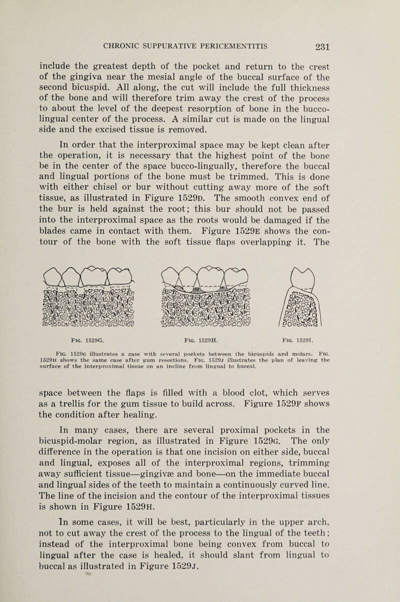 include the greatest depth of the pocket and return to the crest of the gingiva near the mesial angle of the buccal surface of the second bicuspid. All along, the cut will include the full thickness of the bone and will therefore trim away the crest of the process to about the level of the deepest resorption of bone in the bucco- lingual center of the process. A similar cut is made on the lingual side and the excised tissue is removed. In order that the interproximal space may be kept clean after the operation, it is necessary that the highest point of the bone be in the center of the space bucco-lingually, therefore the buccal and lingual portions of the bone must be trimmed. This is done with either chisel or bur without cutting away more of the soft tissue, as illustrated in Figure 1529d. The smooth convex end of the bur is held against the root; this bur should not be passed into the interproximal space as the roots would be damaged if the blades came in contact with them. Figure 1529e shows the con¬ tour of the bone with the soft tissue flaps overlapping it. The Fig. 1529G. Fig. 1529H. Fig. 15291. Fig. 1529g illustrates a case with several pockets between the bicuspids and molars. Fig. 1529h shows the same case after gum resections. Fig. 1529j illustrates the plan of leaving the surface of the interproximal tissue on an incline from lingual to buccal. space between the flaps is filled with a blood clot, which serves as a trellis for the gum tissue to build across. Figure 1529f shows the condition after healing. In many cases, there are several proximal pockets in the bicuspid-molar region, as illustrated in Figure 1529g. The only difference in the operation is that one incision on either side, buccal and lingual, exposes all of the interproximal regions, trimming away sufficient tissue—gingivse and bone—on the immediate buccal and lingual sides of the teeth to maintain a continuously curved line. The line of the incision and the contour of the interproximal tissues is shown in Figure 1529H. In some cases, it will be best, particularly in the upper arch, not to cut away the crest of the process to the lingual of the teeth; instead of the interproximal bone being convex from buccal to lingual after the case is healed, it should slant from lingual to buccal as illustrated in Figure 1529j.