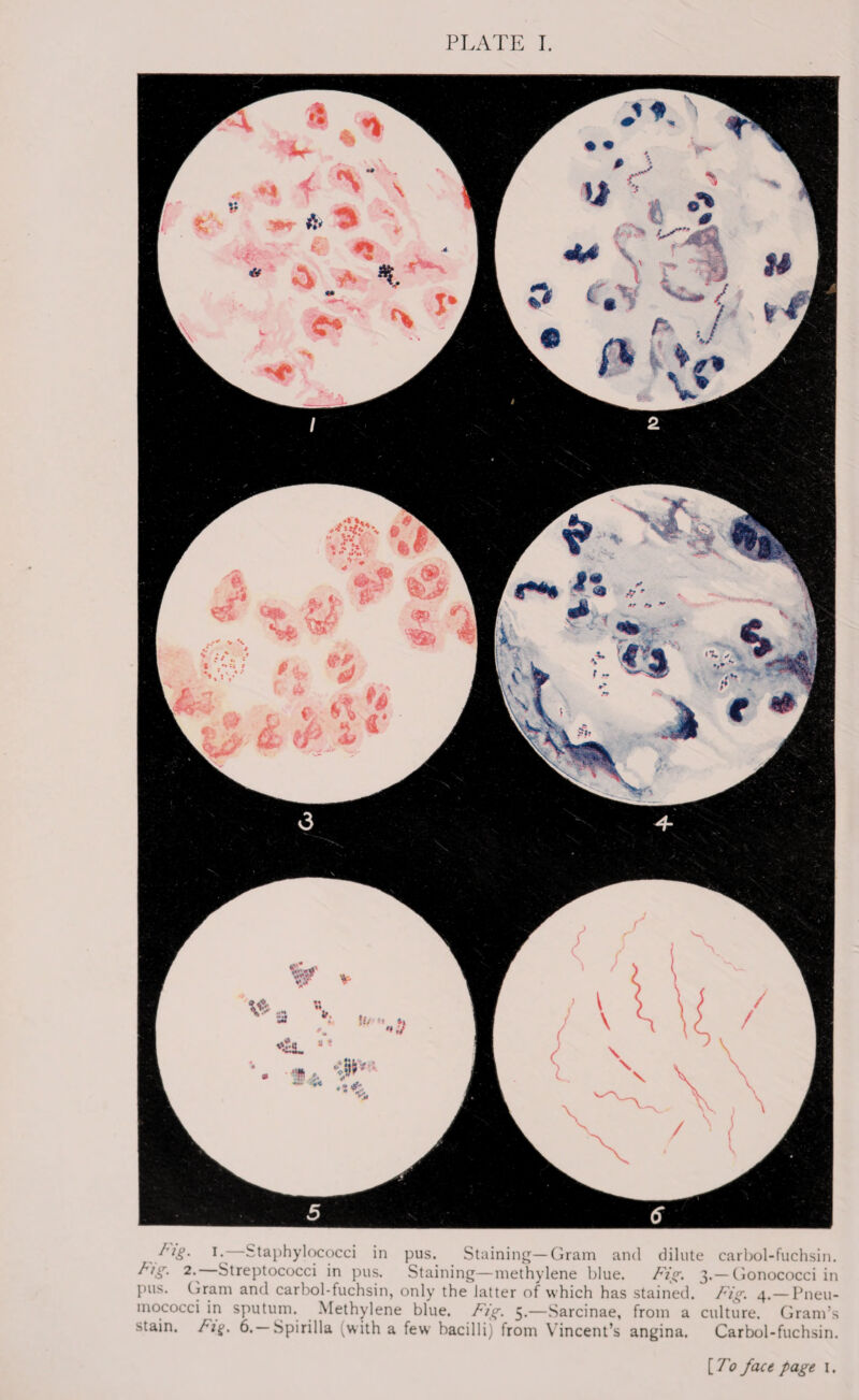 PLATE I. /'/£. I.- Staphylococci in pus. Staining—Gram and dilute carbol-fuchsin. 2- Streptococci in pus. Staining—methylene blue. Fig. 3.— Gonococci in pus. Gram and carbol-fuchsin, only the latter of which has stained. Fig. 4. — Pneu¬ mococci in sputum. Methylene blue. Fig. 5.—Sarcinae, from a culture. Gram’s stain. Fif. 6.-Spirilla (with a few bacilli) from Vincent’s angina. Carbol-fuchsin. [To face page 1.