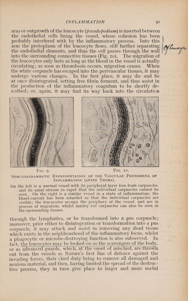 arm or outgrowth of the leucocyte (pseudopodium) is inserted between the endothelial cells lining the vessel, whose cohesion has been probably interfered with by the inflammatory process. Into this arm the protoplasm of the leucocyte flows, still further separating the endothelial elements, and thus the cell passes through the wall into the surrounding connective tissues (Fig. 10). The migration of the leucocytes only lasts as long as the blood in the vessel is actually circulating; as soon as thrombosis occurs, migration ceases. When the white corpuscle has escaped into the perivascular tissues, it may undergo various changes. In the first place, it may die and be at once disintegrated, setting free fibrin ferment, and thus assist in the production of the inflammatory coagulum to be shortly de¬ scribed; or, again, it may find its way back into the circulation Fig. 9. Fig. 10. Semi-diagrammatic Representation of the Vascular Phenomena of Inflammation (after Thoma). On the left is a normal vessel with its peripheral layer free from corpuscles, and its axial stream so rapid that the individual corpuscles cannot be seen. On the right is a similar vessel in a state of inflammation; the blood-current has been retarded so that the individual corpuscles are visible; the leucocytes occupy the periphery of the vessel, and are in process of migration, whilst sundry red corpuscles can also be seen in the surrounding tissues. through the lymphatics, or be transformed into a pus corpuscle; moreover, prior either to disintegration or transformation into a pus corpuscle, it may attack and assist in removing any dead tissue which exists in the neighbourhood of the inflammatory focus, whilst a phagocytic or microbe-destroying function is also subserved. In fact, the leucocytes may be looked on as the scavengers of the body, or as advanced guards, which, at the bnseFof mischief, are thrown out from the vessels as Nature’s first line of defence against the invading forces, their chief duty being to remove all damaged and noxious material, and then, having limited the spread of the destruc¬ tive process, they in turn give place to larger and more useful