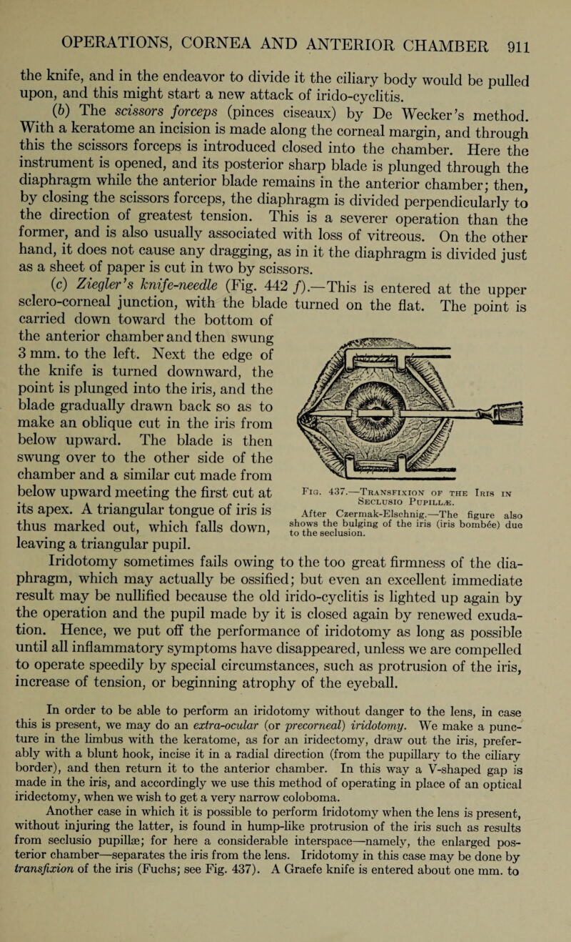 the knife, and in the endeavor to divide it the ciliary body would be pulled upon, and this might start a new attack of irido-cyclitis. (6) The scissors forceps (pinces ciseaux) by De Wecker ’s method. With a keratome an incision is made along the corneal margin, and through this the scissors forceps is introduced closed into the chamber. Here the instrument is opened, and its posterior sharp blade is plunged through the diaphragm while the anterior blade remains in the anterior chamber; then, by closing the scissors forceps, the diaphragm is divided perpendicularly to the direction of greatest tension. This is a severer operation than the former, and is also usually associated with loss of vitreous. On the other hand, it does not cause any dragging, as in it the diaphragm is divided just as a sheet of paper is cut in two by scissors. (c) Ziegler s knife-needle (Fig. 442 /).—This is entered at the upper sclero-corneal junction, with the blade turned on the flat. The point is carried down toward the bottom of the anterior chamber and then swung 3 mm. to the left. Next the edge of the knife is turned downward, the point is plunged into the iris, and the blade gradually drawn back so as to make an oblique cut in the iris from below upward. The blade is then swung over to the other side of the chamber and a similar cut made from below upward meeting the first cut at its apex. A triangular tongue of iris is thus marked out, which falls down, leaving a triangular pupil. Iridotomy sometimes fails owing to the too great firmness of the dia¬ phragm, which may actually be ossified; but even an excellent immediate result may be nullified because the old irido-cyclitis is lighted up again by the operation and the pupil made by it is closed again by renewed exuda¬ tion. Hence, we put off the performance of iridotomy as long as possible until all inflammatory symptoms have disappeared, unless we are compelled to operate speedily by special circumstances, such as protrusion of the iris, increase of tension, or beginning atrophy of the eyeball. Fig. 437.—Transfixion of the Iris in Seclusio Pupillae. After Czermak-Elschnig.—The figure also shows the bulging of the iris (iris bomb6e) due to the seclusion. In order to be able to perform an iridotomy without danger to the lens, in case this is present, we may do an extra-ocular (or precorneal) iridotomy. We make a punc¬ ture in the limbus with the keratome, as for an iridectomy, draw out the iris, prefer¬ ably with a blunt hook, incise it in a radial direction (from the pupillary to the ciliary border), and then return it to the anterior chamber. In this way a V-shaped gap is made in the iris, and accordingly we use this method of operating in place of an optical iridectomy, when we wish to get a very narrow coloboma. Another case in which it is possible to perform Iridotomy when the lens is present, without injuring the latter, is found in hump-like protrusion of the iris such as results from seclusio pupillae; for here a considerable interspace—namely, the enlarged pos¬ terior chamber—separates the iris from the lens. Iridotomy in this case may be done by transfixion of the iris (Fuchs; see Fig. 437). A Graefe knife is entered about one mm. to