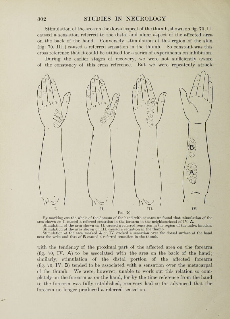 Stimulation of the area on the dorsal aspect of the thumb, shown on fig. 70, II. caused a sensation referred to the distal and ulnar aspect of the affected area on the back of the hand. Conversely, stimulation of this region of the skin (fig. 70, III.) caused a referred sensation in the thumb. So constant was this cross reference that it could be utilised for a series of experiments on inhibition. During the earlier -stages of recovery, we were not sufficiently aware of the constancy of this cross reference. But we were repeatedly struck By marking out the whole of the dorsum of the hand with squares we found that stimulation of the area shown on I. caused a referred sensation in the forearm in the neighbourhood of IV. A. Stimulation of the area shown on II. caused a referred sensation in the region of the index knuckle. Stimulation of the area shown on III. caused a sensation in the thumb. Stimulation of the area marked A on IV. evoked a sensation over the dorsal surface of the hand near the wrist and that of B caused a referred sensation in the thumb. with the tendency of the proximal part of the affected area on the forearm (fig. 70, IV. A) to be associated with the area on the back of the hand; similarly, stimulation of the distal portion of the affected forearm (fig. 70, IV. B) tended to be associated with a sensation over the metacarpal of the thumb. We were, however, unable to work out this relation so com¬ pletely on the forearm as on the hand, for by the time reference from the hand to the forearm was fully established, recovery had so far advanced that the forearm no longer produced a referred sensation.