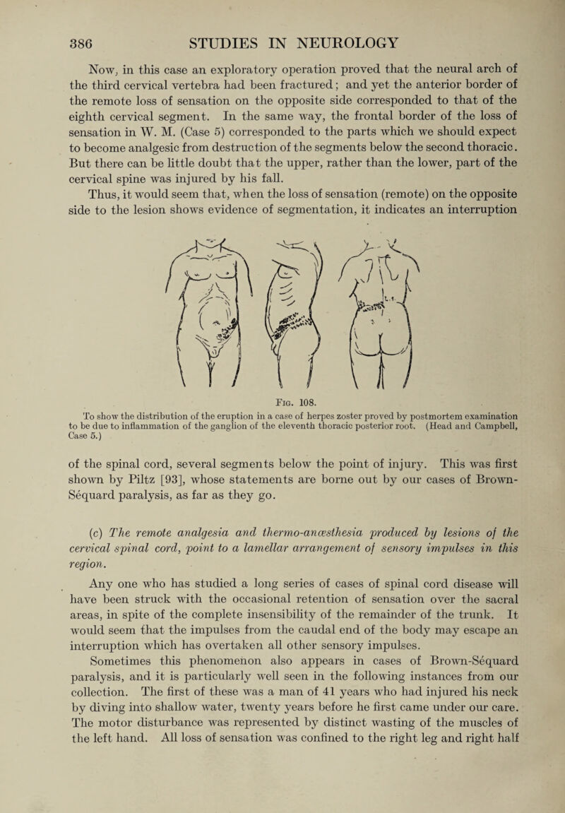 Now, in this case an exploratory operation proved that the neural arch of the third cervical vertebra had been fractured; and yet the anterior border of the remote loss of sensation on the opposite side corresponded to that of the eighth cervical segment. In the same way, the frontal border of the loss of sensation in W. M. (Case 5) corresponded to the parts which we should expect to become analgesic from destruction of the segments below the second thoracic. But there can be little doubt that the upper, rather than the lower, part of the cervical spine was injured by his fall. Thus, it would seem that, when the loss of sensation (remote) on the opposite side to the lesion shows evidence of segmentation, it indicates an interruption Fig. 108. To show the distribution of the eruption in a case of herpes zoster proved by postmortem examination to be due to inflammation of the ganglion of the eleventh thoracic posterior root. (Head and Campbell, Case 5.) of the spinal cord, several segments below the point of injury. This was first shown by Piltz [93], whose statements are borne out by our cases of Brown- Sequard paralysis, as far as they go. (c) The remote analgesia and thermo-ancesthesia 'produced by lesions of the cervical spinal cord, point to a lamellar arrangement of sensory impulses in this region. Any one who has studied a long series of cases of spinal cord disease will have been struck with the occasional retention of sensation over the sacral areas, in spite of the complete insensibility of the remainder of the trunk. It would seem that the impulses from the caudal end of the body may escape an interruption which has overtaken all other sensory impulses. Sometimes this phenomenon also appears in cases of Brown-Sequard paralysis, and it is particularly well seen in the following instances from our collection. The first of these was a man of 41 years who had injured his neck by diving into shallow water, twenty years before he first came under our care. The motor disturbance was represented by distinct wasting of the muscles of the left hand. All loss of sensation was confined to the right leg and right half