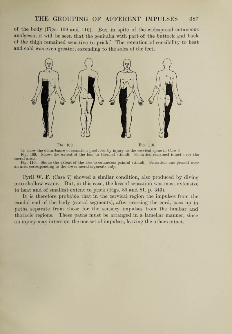 of the body (Figs. 109 and 110). But, in spite of the widespread cutaneous analgesia, it will be seen that the genitalia with part of the buttock and back of the thigh remained sensitive to prick.' The retention of sensibility to heat and cold was even greater, extending to the soles of the feet. To show the disturbance of sensation produced by injury to the cervical spine in Case 6. Fig. 109. Shows the extent of the loss to thermal stimuli. Sensation remained intact over the sacral areas. Fig. 110. Shows the extent of the loss to cutaneous painful stimuli. Sensation was present over an area corresponding to the lower sacral segments only. Cyril W. F. (Case 7) showed a similar condition, also produced by diving into shallow water. But, in this case, the loss of sensation was most extensive to heat and of smallest extent to prick (Figs. 80 and 81, p. 343). It is therefore probable that in the cervical region the impulses from the caudal end of the body (sacral segments), after crossing the cord, pass up in paths separate from those for the sensory impulses from the lumbar and thoracic regions. These paths must be arranged in a lamellar manner, since an injury may interrupt the one set of impulses, leaving the others intact.