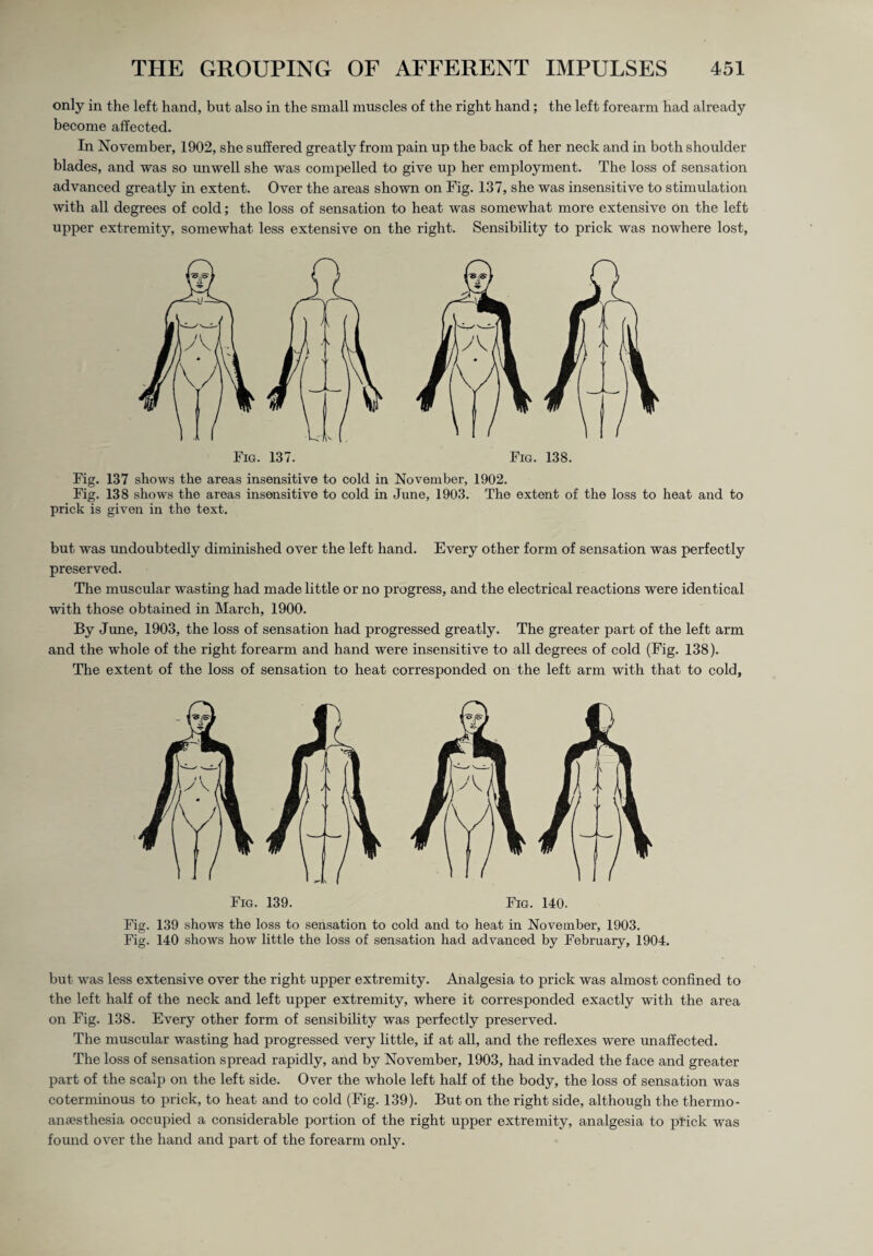 only in the left hand, but also in the small muscles of the right hand; the left forearm had already become affected. In November, 1902, she suffered greatly from pain up the back of her neck and in both shoulder blades, and was so unwell she was compelled to give up her employment. The loss of sensation advanced greatly in extent. Over the areas shown on Fig. 137, she was insensitive to stimulation with all degrees of cold; the loss of sensation to heat was somewhat more extensive on the left upper extremity, somewhat less extensive on the right. Sensibility to prick was nowhere lost, Fig. 138. Fig. 137 shows the areas insensitive to cold in November, 1902. Fig. 138 shows the areas insensitive to cold in June, 1903. The extent of the loss to heat and to prick is given in the text. but was undoubtedly diminished over the left hand. Every other form of sensation was perfectly preserved. The muscular wasting had made little or no progress, and the electrical reactions were identical with those obtained in March, 1900. By June, 1903, the loss of sensation had progressed greatly. The greater part of the left arm and the whole of the right forearm and hand were insensitive to all degrees of cold (Fig. 138). The extent of the loss of sensation to heat corresponded on the left arm with that to cold. Fig. 139. Fig. 140. Fig. 139 shows the loss to sensation to cold and to heat in November, 1903. Fig. 140 shows how little the loss of sensation had advanced by February, 1904. but was less extensive over the right upper extremity. Analgesia to prick was almost confined to the left half of the neck and left upper extremity, where it corresponded exactly with the area on Fig. 138. Every other form of sensibility was perfectly preserved. The muscular wasting had progressed very little, if at all, and the reflexes were unaffected. The loss of sensation spread rapidly, and by November, 1903, had invaded the face and greater part of the scalp on the left side. Over the whole left half of the body, the loss of sensation was coterminous to prick, to heat and to cold (Fig. 139). But on the right side, although the thermo- anaesthesia occupied a considerable portion of the right upper extremity, analgesia to prick was found over the hand and part of the forearm only.