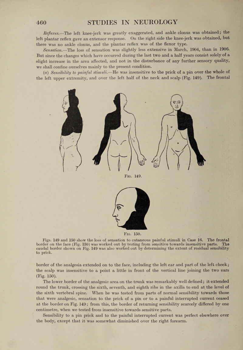 Reflexes—The left knee-jerk was greatly exaggerated, and ankle clonus was obtained; the left plantar reflex gave an extensor response. On the right side the knee-jerk was obtained, but there was no ankle clonus, and the plantar reflex was of the flexor type. Sensation.—The loss of sensation was slightly less extensive in March, 1904, than in 1906. But since the changes which have occurred during the last two and a half years consist solely of a slight increase in the area affected, and not in the disturbance of any further sensory quality, we shall confine ourselves mainly to the present condition. (a) Sensibility to painful stimuli.—He was insensitive to the prick of a pin over the whole of the left upper extremity, and over the left half of the neck and scalp (Fig. 149). The frontal Fig. 149. Fig. 150. Figs. 149 and 150 show the loss of sensation to cutaneous painful stimuli in Case 16. The frontal border on the face (Fig. 150) was worked out by testing from sensitive towards insensitive parts. The caudal border shown on Fig. 149 was also worked out by determining the extent of residual sensibility to prick. border of the analgesia extended on to the face, including the left ear and part of the left cheek; the scalp was insensitive to a point a little in front of the vertical line joining the two ears (Fig. 150). The lower border of the analgesic area on the trunk was remarkably well defined; it extended round the trunk, crossing the sixth, seventh, and eighth ribs in the axilla to end at the level of the sixth vertebral spine. When he was tested from parts of normal sensibility towards those that were analgesic, sensation to the prick of a pin or to a painful interrupted current ceased at the border on Fig. 149; from this, the border of returning sensibility scarcely differed by one centimetre, when we tested from insensitive towards sensitive parts. Sensibility to a pin prick and to the painful interrupted current was perfect elsewhere over the body, except that it was somewhat diminished over the right forearm.
