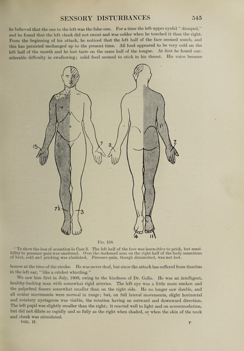 he believed that the one to the left was the false one. For a time the left upper eyelid drooped,” and he found that the left cheek did not sweat and was colder when he touched it than the right. From the beginning of his attack, he noticed that the left half of the face seemed numb, and this has persisted unchanged up to the present time. All food appeared to be very cold on the left half of the mouth and he lost taste on the same half of the tongue. At first he found con¬ siderable difficulty in swallowing; solid food seemed to stick in his throat. His voice became ' To show the loss of sensation in Case 3. The left half of the face was insensitive to prick, but sensi¬ bility to pressure-pain was unaltered. Over the darkened area on the right half of the body sensations of heat, cold and pricking was abolished. Pressure-pain, though diminished, was not lost. hoarse at the time of the stroke. He was never deaf, but since the attack has suffered from tinnitus in the left ear, '£ like a cricket whistling.” We saw him first in July, 1909, owing to the kindness of Dr. Golla. He was an intelligent, healthy-looking man with somewhat rigid arteries. The left eye was a little more sunken and the palpebral fissure somewhat smaller than on the right side. He no longer saw double, and all ocular movements were normal in range; but, on full lateral movements, slight horizontal and rotatory nystagmus was visible, the rotation having an outward and downward direction. The left pupil was slightly smaller than the right; it reacted well to light and on accommodation, but did not dilate so rapidly and so fully as the right when shaded, or when the skin of the neck and cheek was stimulated. VOL. IT. P