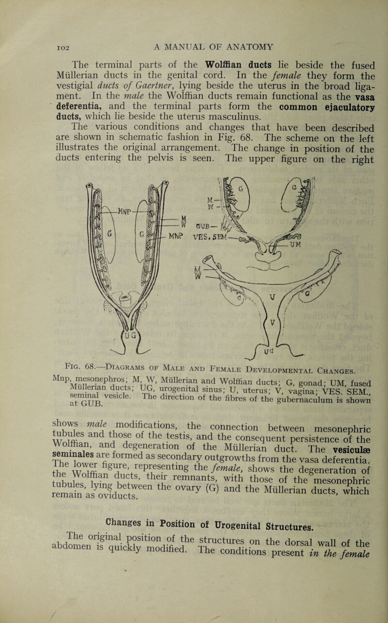 The terminal parts of the Wolffian ducts lie beside the fused Mullerian ducts in the genital cord. In the female they form the vestigial ducts of Gaertner, lying beside the uterus in the broad liga¬ ment. In the male the Wolffian ducts remain functional as the vasa deferentia, and the terminal parts form the common ejaculatory ducts, which lie beside the uterus masculinus. The various conditions and changes that have been described are shown in schematic fashion in Fig. 68. The scheme on the left illustrates the original arrangement. The change in position of the ducts entering the pelvis is seen. The upper figure on the right FIG. 68.—Diagrams of Male and Female Developmental Changes. MnpWmnSOnephJrOS; M' W' Mmierian and Wolffian ducts; G, gonad* UM fused Mullerian ducts; UG, urogenital sinus; U, uterus; V, vagina; VES. SEM., ™B VGS1Cle‘ The dlrectlon of the fibres of the gubernaculum is shown tnWffiQ mo^hications, the connection between mesonephric WnffiffiTiand °f the teStlS’ and the consequent persistence of the Wolffian, and degeneration of the Mullerian duct. The vesicuEe ThTlowerafiLf°rmed as sec°ndary outgrowths from the vasa deferentia. the Wolffion^r|reVre^d?S^ntln^ fema^e> shows the degeneration of hnT hnn , nCt ' th!lr remnan,ts’ with those of the mesonephric remak ’asTidSr6 (G) and the MMerian ducts’ which Changes in Position of Urogenital Structures. orjginal position of the structures on the dorsal wall of the abdomen as qmckly modified. The conditions presen tin Ike female / / ./