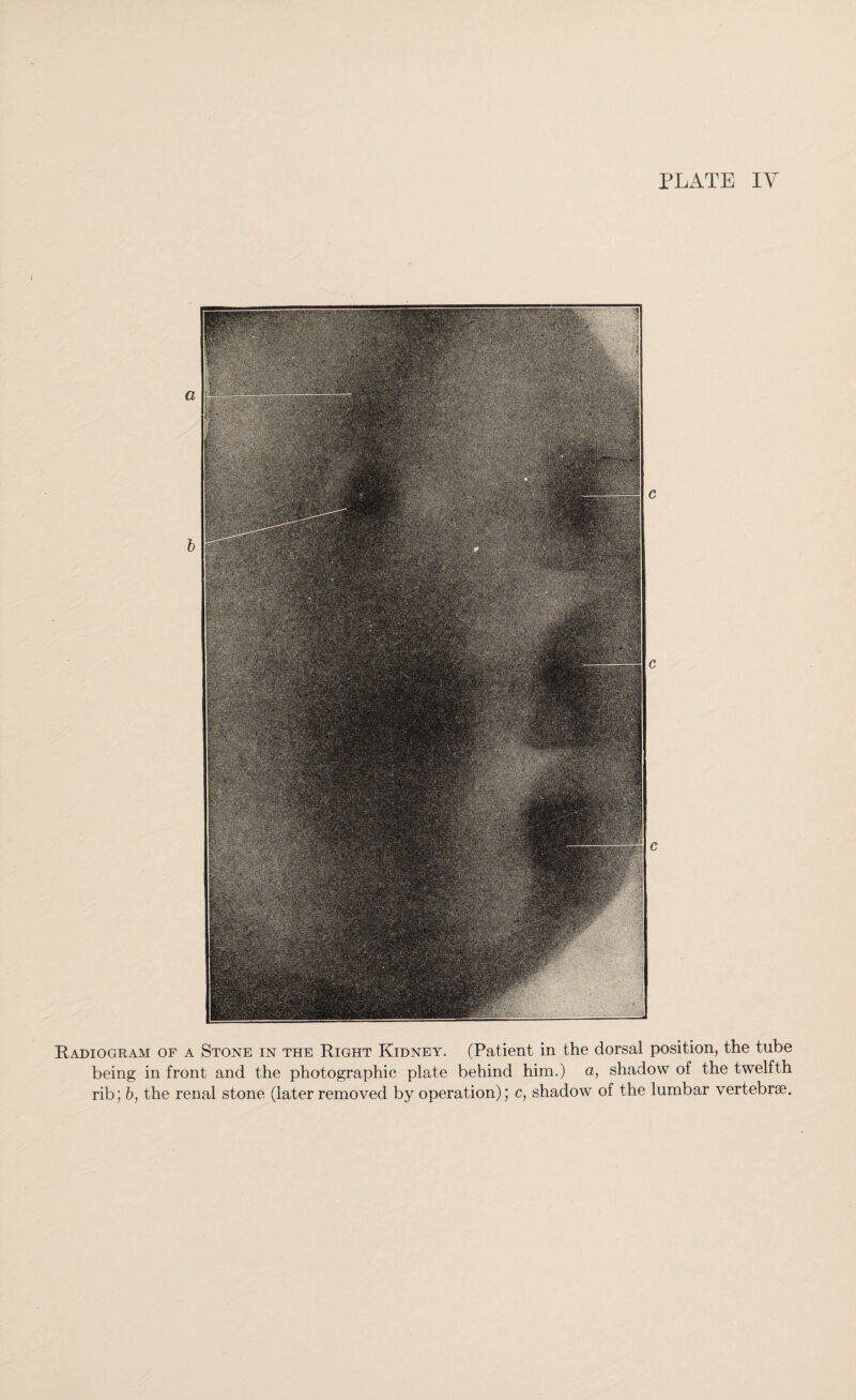 PLATE IY Radiogram of a Stone in the Right Kidney. (Patient in the dorsal position, the tube being in front and the photographic plate behind him.) a, shadow of the twelfth rib; b, the renal stone (later removed by operation); c, shadow of the lumbar vertebrae.
