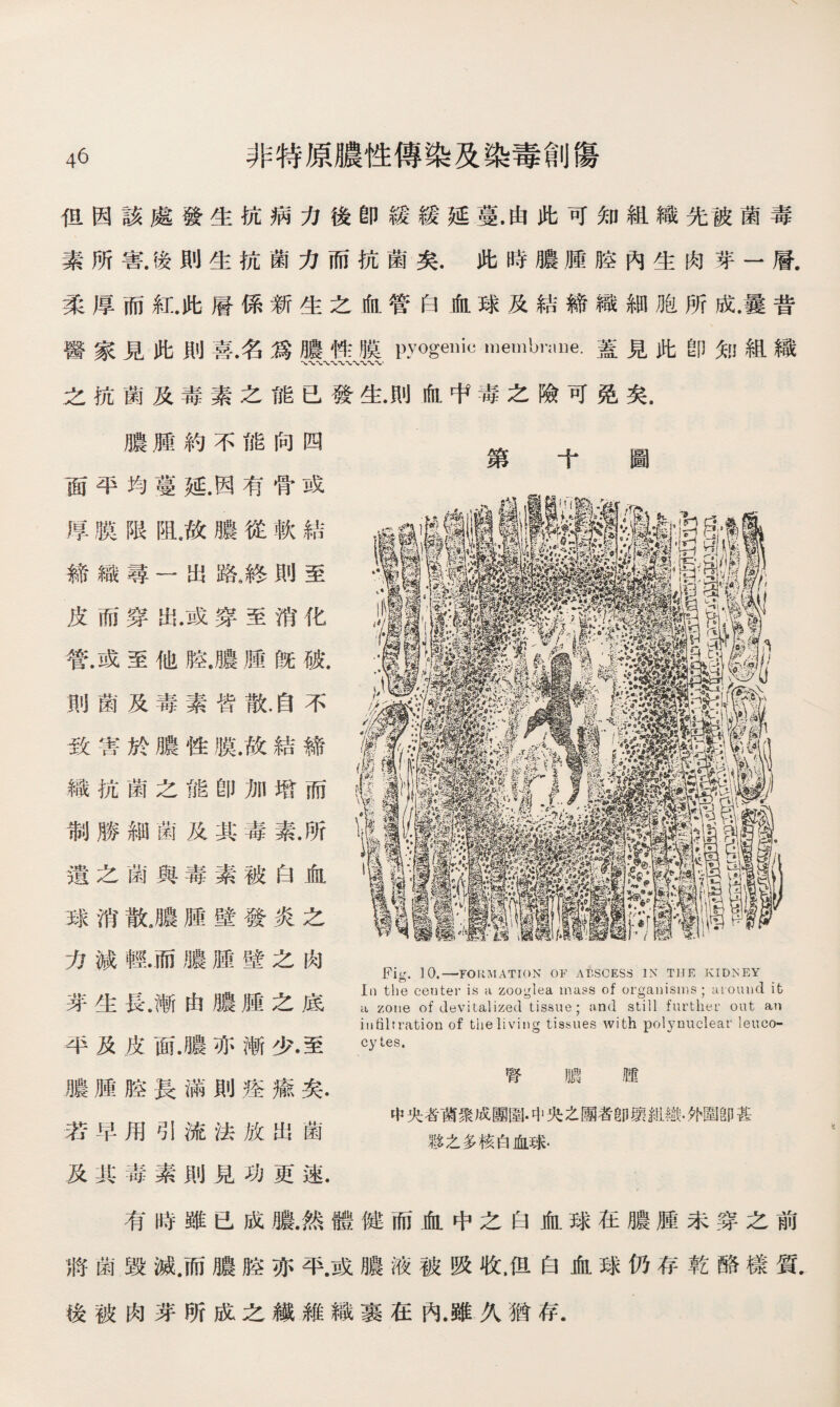 但因該處發生抗病力後卽緩緩延蔓.由此可知組織先被菌毒 素所害.後則生抗菌力而抗菌矣.此時膿腫腔內生肉芽一層. 柔厚而紅.此層係新生之血管白血球及結締織細胞所成.曩昔 醫家見此則喜.名爲膿性膜pyogenic membraDe.蓋見此卽知組織 〜〜〜〜〜w〜〜w 之抗菌及毒素之能已發生.則血中毒之險可免矣. 膿腫約不能向四 面平均蔓延.因有骨或 厚膜限虬故膿從軟結 締織尋一出路,終則至 皮而穿出.或穿至消化 管.或至他腔.膿腫旣破. 則菌及毒素皆散.自不 致害於膿性膜.故結締 織抗菌之能卽加增而 制勝細菌及其毒素.所 遺之菌與毒素被白血 球消散J農腫壁發炎之 力減輕•而膿腫壁之肉 芽生長.漸由膿腫之底 平及皮面.膿亦漸少.至 膿腫腔長滿則痊瘉矣. 若早用引流法放出菌 及其毒素則見功更速. 第十圖 Fig. 10. —FORMATION OF ABSCESS IN THE KIDNEY la the center is a zooglea mass of organisms ; aiound it a zone of devitalized tissue; and still further out an infiltration of the living tissues with polynuclear leuco¬ cytes. 腎 m 腫 中央者菌聚成團圍•中央之團者卽壞紐織.外圍卽甚 夥之多核白血球. 有時雖已成膿.然體健而血中之白血球在膿腫未穿之前 將菌毁滅.而膿腔亦平.或膿液被吸收，但白血球仍存乾酪樣質. 後被肉芽所成之繊維織裹在內.雖久猶存.