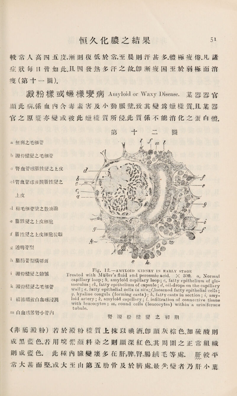較常人高四五度.漸則復低於常•至晨則汗甚多.體極疲倦.凡諸 症狀每日皆如此8且因發熟多汗之故，卽漸疲困至於弱極而消 痩（第十一圖). 澱粉樣或蟣樣變病Amyloid or Waxy Disease•某器器官 •顯此病•係血內含毒素害及小動脈壁•致其變爲蠟樣質，且某器 官之原漿亦變或被此蠟樣質所侵，此質係不能消化之蛋白體. ^無病之毛細管 b澱盼樣變之毛細管 3腎血管球脂性變之上皮 41膂血管球波膜脂性變之 上皮 d粘毛細管壁之數油滴 «脂性變之上皮細胞 i脂性變之上皮細胞脱離 5透叨管型 h脂肪管型橫切面 i澱粉樣變之動脈 k搬粉樣變之毛細營 1結締織波6血球沒潤 - m白血钱居腎小管內 Fig. 12.—AMYLOID KIDNEY IN EARLY STAGE Treated with Mulleins fluid and perosmic acid. X 300. a, Normal capillary loop; b, amyloid capillary loop; c, fatty epithelium of glo¬ merulus ;cl, fatty epithelium of capsule ; d, oil-drops on the capillary wall ; e, fatty epithelial cells in loosened fatty epithelial cells; (J、hyaline coagula (forming casts)； h, fatfy casts iu section ; i, amy: loid artet-y ; k, amyloid capillary; l. infiltration of eonneccive tissue with leucocytes ; wj, round cells (leucocytes) within a uriniferous tubule. 腎澱粉樣變之初期 <非屬澱粉）若於澱粉樣質上抹以碘酒.卽顯灰棕色„加硫酸則 成黑藍色•若用垸紫颜料染之則顯深紅色，其周圍之正常組織 則成藍色.此M內臟變壤多在肝，脾，腎，腸絨毛等處.肝較平 常大甚而堅•或大至由第五肋骨及於臍處•最失變者乃肝小葉