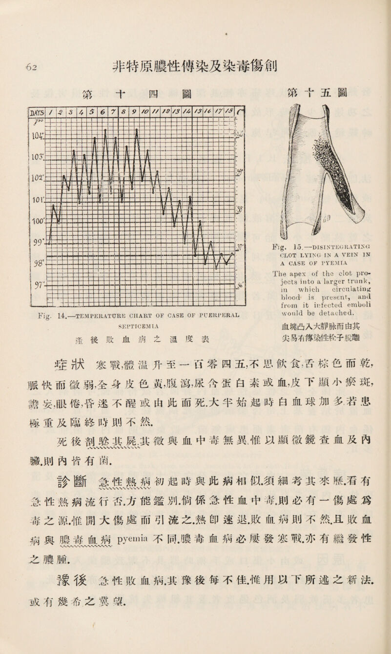 筮 十四圖 第十五圖 Fig. 15.一DISINTEGRATING CLOT LYING IN A VEIN IN A CASE OF PYEMIA The apex of the clot pro jects into a larger trunk, in which circulating l)lood is present, and from ifc infected emboli would be detached. 血塊凸入大靜脉而由其 尖易有傳染性栓子脫離 症狀寒戰，體温升至一 H零四五，不思飮食，舌棕色而乾r 脈快而微弱，全身皮色黃，腹瀉，尿含蛋白素或血，皮下顯小瘀斑， 譫妄，眼倦，昏速不醒或由此而死.大半始起時白血球加多若患 極重及臨終時則不然• 死後剖驗其屍，其徵與血中毒無異.惟以顯微鏡查血及內 臟.則內皆有菌. 診斷急性熟病初起時與此病相似•須細考其來歷•看有 急性熱病流行否,方能鑑別•倘係急性血中毒。則必有一傷處爲 毒之源.惟開大傷處而引流之•熟卽速退•敗血病則不然.且敗血 病與膿毒血病pyemia不同•噥毒血病必屢發寒戰•亦有繼發性 之膿腫. 豫後急性敗血病.其豫後每不佳.惟用以下所述之新法• 第 十四圖 或有幾希之冀望.