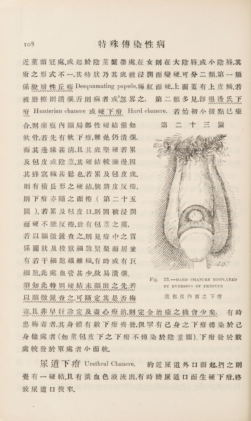近莖頭冠處.或起於陰莖繫帶處.在女則在大陰脣.或小陰脣.其 瘡之形式不一.其特狀乃其底被浸潤而變硬.可分二類.第一類 係脫屑性丘疹Desquamating papule•極紅而硬.上面蓋有上皮鱗.若 被磨擦則潰爛.否則病者或3忽畧之，第二類多見.卽很透氏下 八〜〜-V- 抵Hunterian chancre或硬下祗Hard chancre.若始初小破點已瘉 合.則瘢痕內顯局部性硬結儼如 第二十三圖 軟骨.若先有軟下疳.難免仍潰爛. 而其邊緣甚淸其底堅硬若累 及包皮或陰莖.其硬結較瀰漫，因 其蜂窩織甚鬆也9若累及包皮底. 則有橫長形之硬結.倘將皮反捲， 則下疳亦隨之而捲（第二十五 圖X若累及包皮口9則因被浸潤 而硬不能反捲.致有包莖之虞. 若以顯微鏡查之.則見疳中之質 係圓狀及梭狀細皰緊聚而居兼 有若干細胞纖雜織.有時或有巨 細胞^此處血管甚少.故易潰爛， 須知此特別硬結未顯出之先，若 以顯微鏡查之，可斷定其是否梅 八〜〜〜〜〜〜、〜〜、WW〜〜〜*W、W〜\ 毒8 R非早行診定及盡心療治•則完全治瘉之機會少矣.有時 患梅毒者，其身體有數下疳齊發9伹罕有己身之下疳傳染於己 身他處者（如莖包皮下之下疳不傳染於陰莖頭），下疳發於數 處較發於單處者小而軟. 尿道下痕Urethral Chancre. 約近尿道外D而起,把之則 覺有一硬結.且有淡血色液流出，有時繞尿道口而生硬下疳.終 致尿道口狹窄. Fig. 23. — HAKD CHANCRE DISPLAYED BY EVERSION OF PREPUCE 莖包皮內靣之下疳