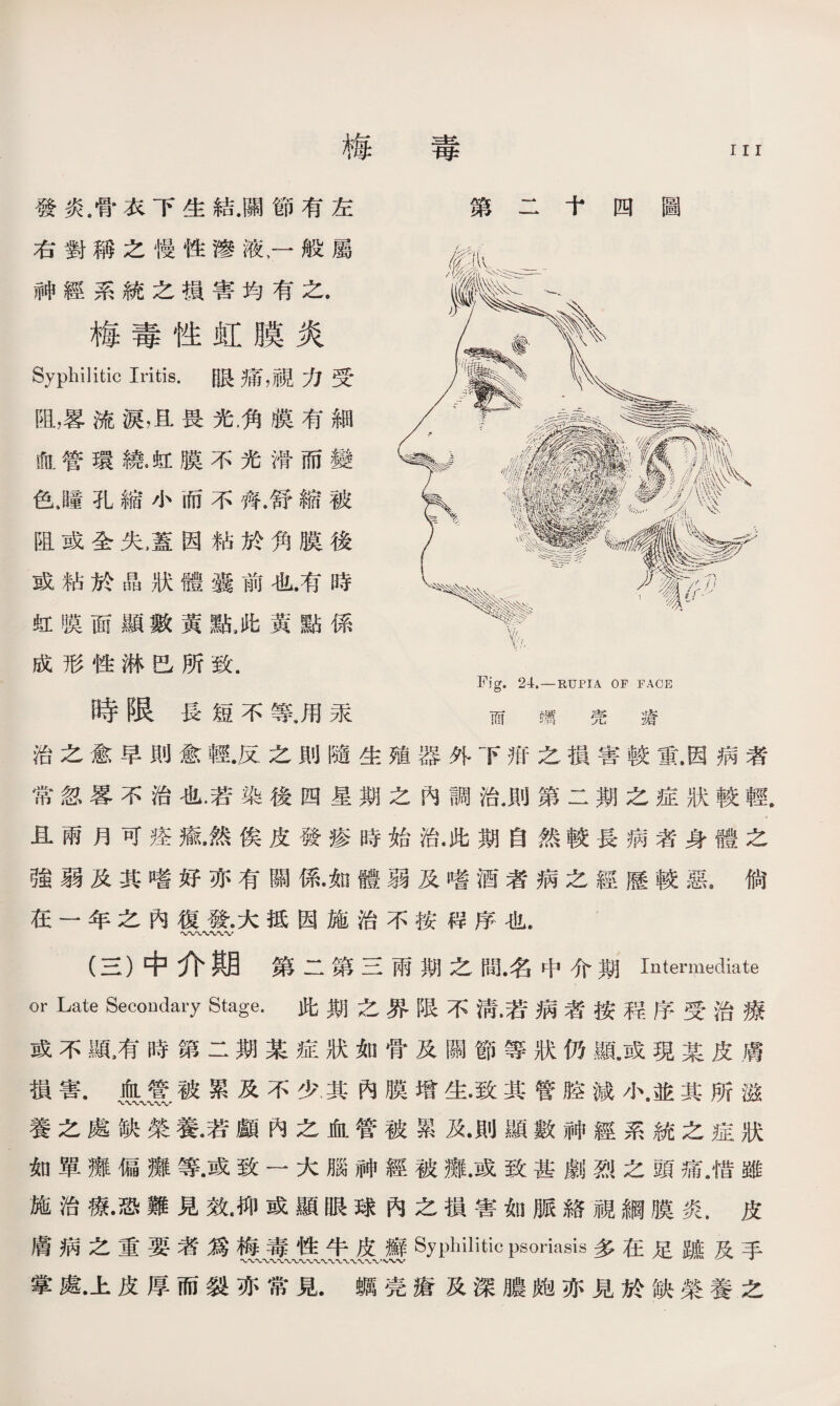 第二十四圖 發炎.骨衣下生結.關節有左 右對稱之慢性滲液，一般屬 神經系統之損害均有之. 梅毒性虹膜炎 Syphilitic Iritis•眼痛，視力受 阻，畧流淚，且畏光，角膜有細 血管環繞•虹膜不光滑而變 色J童孔縮小而不齊.舒縮被 阻或全失M因粘於角膜後 或粘於晶狀體囊前也.有時 虹膜面顯數黃點,此黃點係 成形性淋巴所致. 時限長短不等.用汞 而 m 壳 瘡 治之愈早則愈輕.反之則隨生殖器外下疳之損害較重,因病者 常忽畧不治也.若染後四星期之內調治.則第二期之症狀較輕. 且兩月可痊瘉.然俟皮發疹時始治•此期自然較長病者身體之 強弱及其嗜好亦有關係•如體弱及嗜酒者病之經歷較惡。倘 在一年之內復發•大抵因施治不按稃序也. (三）中介期第二第三雨期之間•名中介期Intermediate or Late Secondary Stage. 此期之界限不淸•若病者按程序受治療 或不顯，有時第二期某症狀如骨及關節等狀仍亂或現某皮膚 損害.血管.被累及不少，其內膜增生•致其管腔減小，並其所滋 養之處缺榮養•若顱內之血管被累及•則顯數神經系統之症狀 如單癱偏癱等.或致一大腦神經被癱.或致甚劇烈之頭痛.惜雖 施治療•恐難見效•抑或顯眼球內之損害如脈絡視綱膜炎.皮 膚病之重要者爲梅毒性牛皮癬Syphilitic psoriasis多在足踮及手 掌處•上皮厚而裂亦常見.蠣壳瘡及深膿皰亦見於缺榮養之