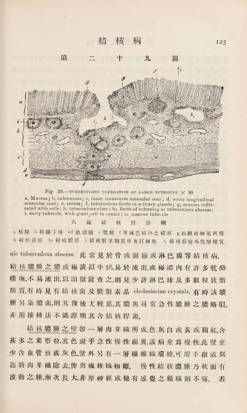 第 結核病 圖 二十九 Fig. 29.■—TUBERCULOUS ULCERATION OF LARGE INTESTINE X 30 a, Mucosa; b, subimicosa; c, inner transverse muscular coat; d, outer longitudinal muscular coat; e, &erosa; f, tuberculous focus in solitary glands; g, mucosa infilt- rated with cells ; h, tuberculous ulcer ; hi，focus of softening or tuberculous abscess; i，early tubercle, with giant^cell in centre ; ii, caseous tubei cle 大 腸 結 核 性 潰 彌 a粘膜b粘膜下層cd肌織膜e漿膜f單淋巴緒內之緒核g粘膜被細胞所健 h結核潰瘠h結核膿腫i結核粒早期其中有巨細胞it結核粒變成乾酪樣質: uic ^^erculous abscess.此常見於骨或關節或淋巴腺等結核病. 氣嚴應ii名ii或極淡似牛奶•易於流出.或極濃內有許多乾酪 樣塊•不易流出•以顯微鏡查之，則見少許淋巴球及多數粒狀脂 肪質•有時見有結核菌及膽脂素晶cholesterine crystals.有時該膿 腫另染膿菌•則其豫後尤較惡•其膿與尋常急性膿腫之膿略似. 非用接種法不能證明其含結核桿菌. 變雲卽一層肉芽織所成.色灰白或黃或稍紅.含 甚多之粟形粒•其色視乎急性慢性而異.該病愈爲慢性.此壁愈 少含血管致成灰色•壁外另有一層繊雜織環繞.可用手指或刮 匙將肉芽織除去•俾與繊雜織相離.慢性結核膿腫乃軟而有 波動之腫•漸次長大•非壓神經或他有感覺之組織則不痛•若