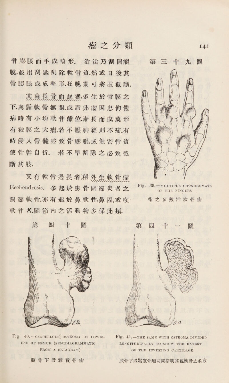 瘤之分類 骨膨脹而手成畸形.治法乃割開瘤 膜•並用刮匙刮除軟骨質.然或日後其 骨膨脹或成畸形.在晚期可將肢截斷. 其由長骨而起者•多生於骨膜之 下•與S后軟骨無關•或謂此瘤因患佝僂 病時有小塊軟骨離位•漸長而成葉形 有被膜之大瘤.若不壓神經則不痛.有 時侵入骨髓腔致骨膨脹.或蝕密骨質 使骨幹自折.若不早割除之必致截 斷其肢. 又有軟骨過長者.稱外生軟骨瘤 Ecchoudrosis.多起於患骨關節炎者之 關節軟骨•亦有起於鼻軟骨，鼻隔，或喉 軟骨者•關節內之活動物多係此類. 指之多數性軟骨痫 四 第四十一圖 Fig. 4 0. — CANCELLOUS1； OSTEOMA OF LOWER END OF FEMUR (SEMIDIAGRAMMATIC FROM A SKIAGRAM) LONGITUDINALLY TO SHOW THE EXTENT OF THE INVESTING CARTILAGE 股骨下段鬆質骨瘤 殷骨下段鬆質骨痫切開指明其包軟骨之多E
