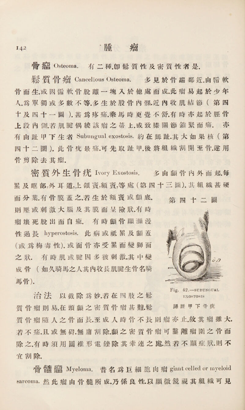 骨瘤Osteoma.有二種.卽鬆質性及密質性者是. 鬆質骨瘤Cancellous Osteoma. 多見於骨端鄰近.由阪軟 骨而生.或因f后軟骨脫離一塊入於他處而成.此瘤易起於少年 人.爲單獨或多數不等•多生於股骨內■•近內收肌結節（第四 十及四十一圖）.甚爲疼痛.乘馬時更覺不舒.有時亦起於脛骨 上段內側.若肌腱偶繞該瘤之蒂上.或致膝關節鎖緊而痛.亦 有由趾甲下生者Subungual exostosis.約在姆趾•其大如果核（第 四十二圜）.此骨疣最痛.可先取趾甲.後將組織割開至骨•遂用 骨剪除去其瘤. 密質外生骨抚Ivory Exostosis, 多由顱骨內外而起•每 累及眶部，外耳道，上頜Sf，額竇，等處（第四十三圖）•其組織甚硬 而分葉.有骨膜蓋之•若生於額竇或顱底. 則壓或刺激大腦及其膜而呈險狀•有時 瘤壤死脫岀而自瘉.有時顱骨顯_漫 性過長hyperostosis.此病或祗累及顱蓋 (或爲梅毒性).或面骨亦受累而變獅面 之狀.有時肌或腱因多被刺激•其中變 成骨（如久騎馬之人其內收長肌腱生骨名騎 馬骨). Fig, 42.—SUEUNGUAL 治法以截除爲妙.若在四肢之鬆 EXOSTOSTS 質骨瘤則易•在頭顱之密質骨瘤甚難•鬆 mm ^ y 質骨瘤隨人之骨而長•至成人時骨不長則瘤亦止•故其瘤雖大. 若不痛•且或無碍•無庸割除•顱之密質骨瘤可靈離瘤圍之骨而 除之.有時須用圓椎形電銼除其牽連之處•然若不顯症狀•則不 宜割除. 骨髓_ Myeloma.昔名爲巨細胞肉瘤giant celled or myeloid sarcoma.然此瘤由骨髓所成•乃係良性•以顯微鏡視其組織可見