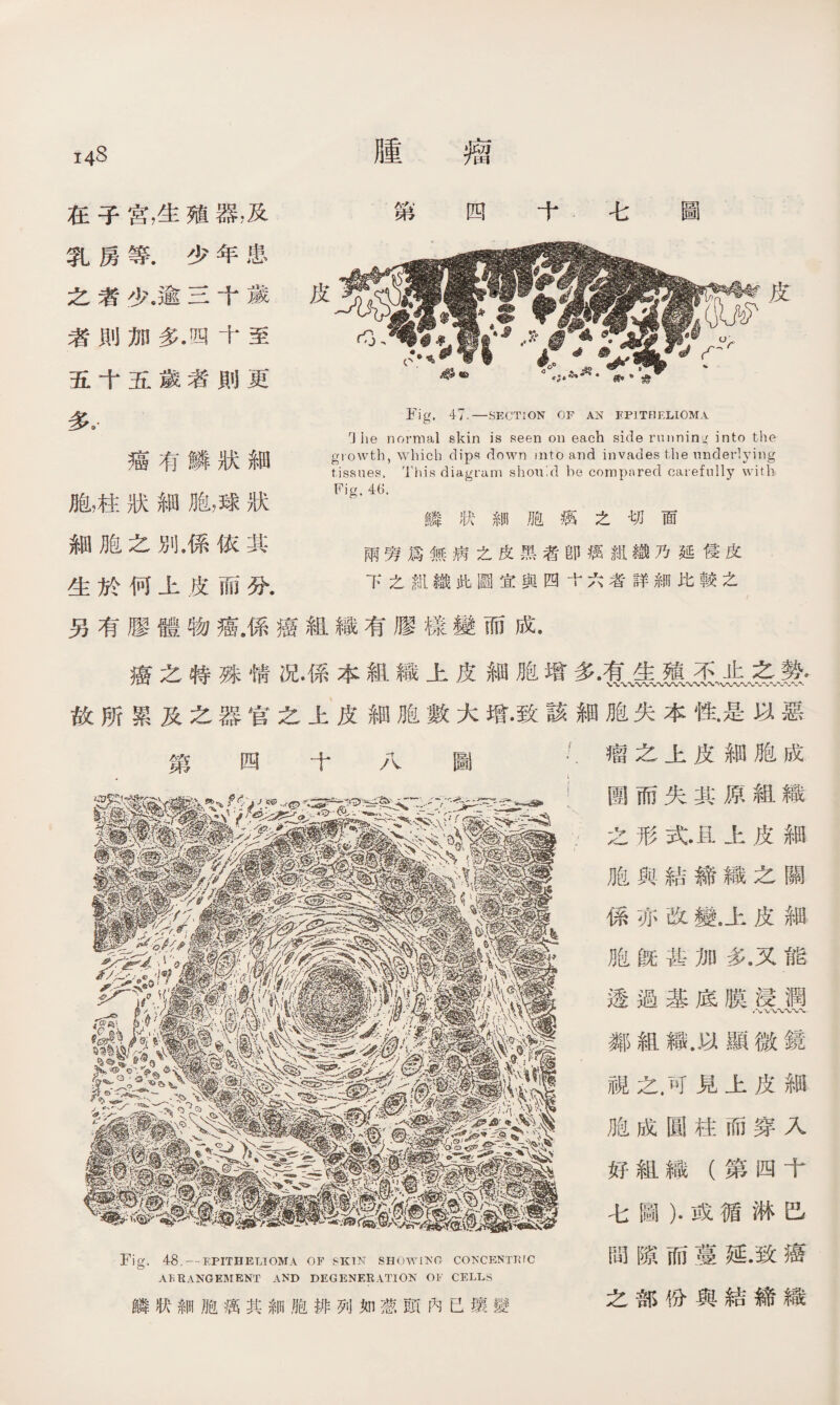 14^ 在子宫，生殖器，及 第 四十七 圖 乳房等.少年患 之者少.逾三十歲 者則加多.四十至 五十五歲者則更 Fig. 47.—SECTION OF AN EP1THF.LI0MA r] lie normal skin is seen on each side running into the growth, which dips down into and invades the underlying tissues. This diagram should be compared carefully with Fig. 46. 鱗狀細胞癘之切面 兩旁爲無病之皮黑者卽癘組織乃延侵皮 下之組織此圖宜與四十六者詳細比較之 另有膠體物癌.係癌組織有膠樣變而成. 多》 癌有鱗狀細 胞，柱狀細胞，球狀 細胞之別,係依其 生於何上皮而分. 癌之特殊情况•係本組織上皮細胞增多•有生殖不」t之勢♦ 故所累及之器官之上皮細胞數大增•致該細胞失本性•是以惡 第四十 八 圖 瘤之上皮細胞成 圑而失其原組織 之形式上皮細 胞與結締織之關 係亦改變.上皮細 胞旣甚加多.又能 透過基底膜浸潤 鄰組織.以顯微鏡 視之.可見上皮細 胞成圓柱而穿入 好組織（第四十 七圖）.或循淋巴 Fig. 48.—--EPITHELIOMA OF 8KIN SHOWIKO CONCENTKTC 間隙而蔓延.致癌 AERANGEMENT AND DEGENERATION Cl«' CELLS 鱗状細胞癘其細胞排列如葱頭內已壤變 之部份與結締織