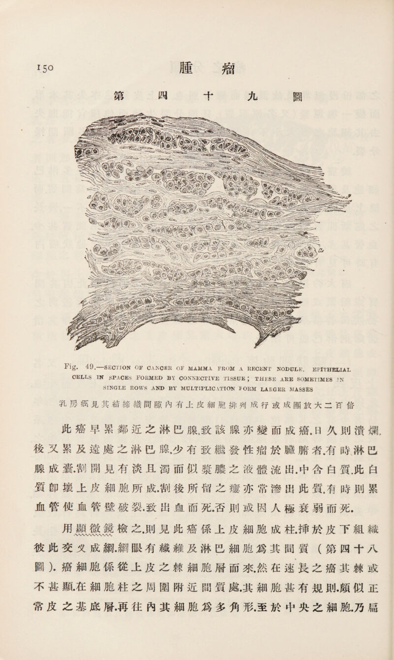 i5o 第 腫 瘤 圖 四十九 Fig. 49.—SECTION OF CAKCER OF MAMMA FROM A RECENT NODULE. EPITHELIAL CELLS IN SPACES FORMED BY CONNECTIVE TISSUE ； THESE AEE SOMETIMES JN SINGLE ROWS AND BY MULTIPLICATION PORM LARGER MASSES 乳房癘見其結締織間隙內有上皮細胞排列成行或成圑放大二百倍 此癌早累鄰近之淋巴腺5致該腺亦變而成癌#日久則潰爛, 後又累及遠處之淋巴鼠少有致繼發性瘤於臟腑者.有時淋巴 腺成囊•割開見有淡K濁而似漿膿之液體流出.中含白質.此白 質卽壤上皮細胞所成•割後所留之瘻亦常滲出此質，有時則累 血管使血管壁破裂•致出血而死•否則或因人極衰弱而死. 用顯微鏡檢之.則見此癌係上皮細胞成柱.挿於皮下組織 彼此交义成綱•綱眼有纖雜及淋巴細胞爲其間質（第四十八 圖）.癌細胞係從上皮之棘細胞層而來•然在速長之癌其棘或 不甚亂在細胞柱之周圍附近間質處.其細胞甚有規則.頗似正 常皮之基底層•再往內其細胞爲多角形.至於中央之細胞.乃扁