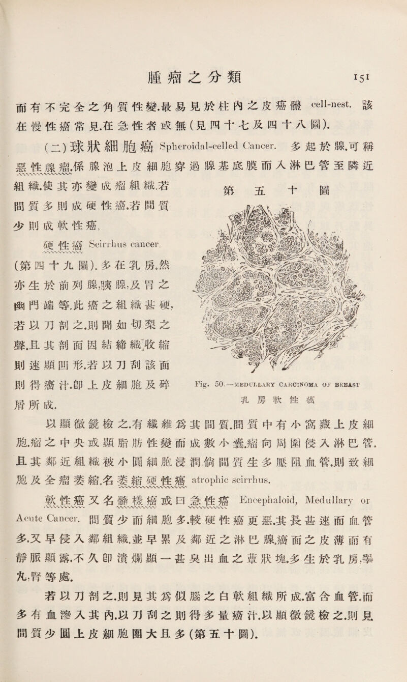 而有不完全之角質性變•最易見於柱內之皮癌體cell-nest.該 在慢性癌常見.在急性者或無（見四十七及四十八圖）• (二）球狀細胞癌Spheroidal-celled Cancer.多起於腺，可稱 惡性腺瘤.係腺泡上皮細胞穿過腺基底膜而入淋巴管至隣近 組織.使其亦變成瘤組織老 間質多則成硬性癌•若間質 少則成軟性癌， 石更1生 '癌 Scirrlms cancer. (第四十九圖）s多在乳房9然 亦生於前列腺，膜腺，及胃之 幽門端等，此癌之組織甚硬， 若以刀剖之.則聞如切梨之 聲.且其剖面因結締織:收縮 則速顯問形.若以刀刮該面 則得癌汁.卽上皮細胞及碎 滑所成. 第 五十圖 Fig. 50 —MEDULLARY CARCINOMA OF BREAST 乳房軟性癘 以顯微鏡檢之.有纖雜爲其間質.間質中有小窩藏上皮細 胞.瘤之中央或顯脂肪性變而成數小囊.瘤向周圍侵入淋巴管s 且其鄰近組織被小圓細胞浸潤倘間質生多壓阻血管.則致細 胞及全瘤萎縮名萎縮硬性癌atrophic scirrlms. 軟性癌又名髓樣癌或曰急性癌Encephaloid, Medullary or Acute Canw.間質少而細胞多•較硬性癌更惡.其長甚速而血管 多•又早侵入鄰組織.並早累及鄰近之淋巴腺Jff面之皮薄而有 靜脈顯露•不久卽潰爛顯一甚臭出血之蕈狀塊8多生於乳房，擧 凡.腎等處. 若以刀剖之.則見其爲似腦之白軟組織所成.富含血管.而 多有血滲入其內.以刀刮之則得多量癌汁.以顯微鏡檢之.則見 間質少圓上皮細胞圑大旦多（第五十圖）.