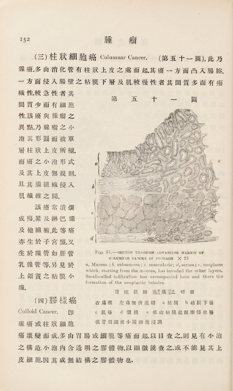 (三）柱狀細胞癌 Columnar Cancer. (第五十一圖）•此乃 腺癌•多由消化管有柱狀上皮之處而起.其癌一方面凸入腸腔. 一方面侵入腸壁之粘膜下層及肌，較慢性者其間質多而有瘢 織性•較急性者其 間質少而有細胞 性，該癌與腺瘤之 異點.乃腺瘤之小 泡郛形圓而被單 層柱狀上皮所襯. 而癌之小泡形式 及其上皮無規則. iL其腺組織侵入 肌纖維之間. 該癌常潰爛 成瘍.累及淋巴腺 及他臟腑,此等癌 亦生於子宮頸.又 生於腺管如肝管 乳腺管等,另見於 上頜竇之粘膜小 腺. (四）膠樣癌 第五十 一圖 Fig. 51.一SECTION THROUGH ADVANCING MARGIN OF COLUMNAR CANCER OF STOMACH. X 25 a, Mucosa ； b, submucosa ; c, muscalaris ; c/, serosa; e, neoplasm which, starting from the mucosa, has invaded tlie other layers, Small-celled infiltration has accompanied here and there the formation of the neoplastic tubules, 胃柱狀細胞墨癘I之切面 右爲癘左爲無病組織 a粘膜 b粘膜下層 Colloid Cancer. 卽 c肌層 d漿膜 e瘓由粘膜起而漸侵他層 腺癌或柱狀細胞 厲管周圍被小圓細胞浸潤 癌壤變而成，多由胃腸或綱膜等癌而起.以目査之.則見有小泡 之構造.小泡內含透明之膠體物.以顯微鏡查之.或不能見其上 皮細胞•因其成無結構之膠體物也.